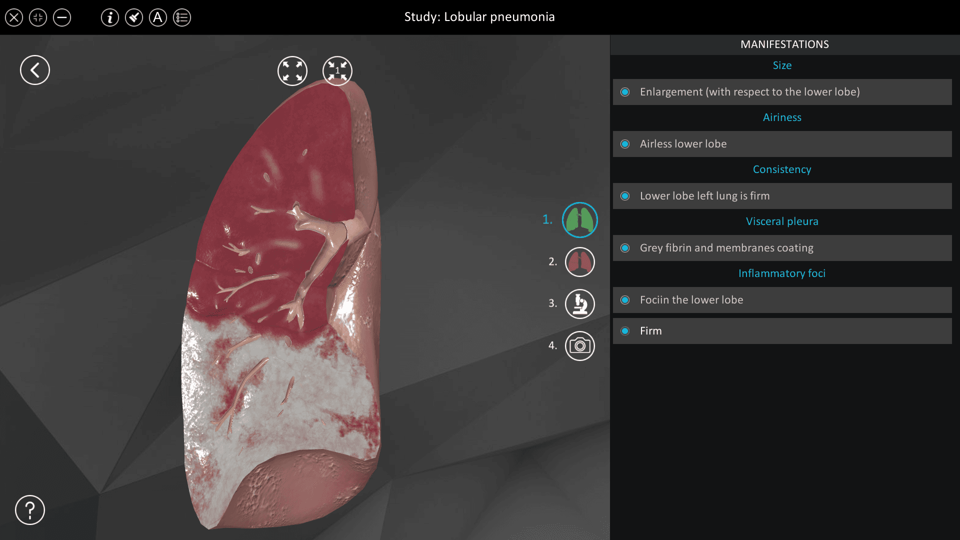 Lobular pneumonia