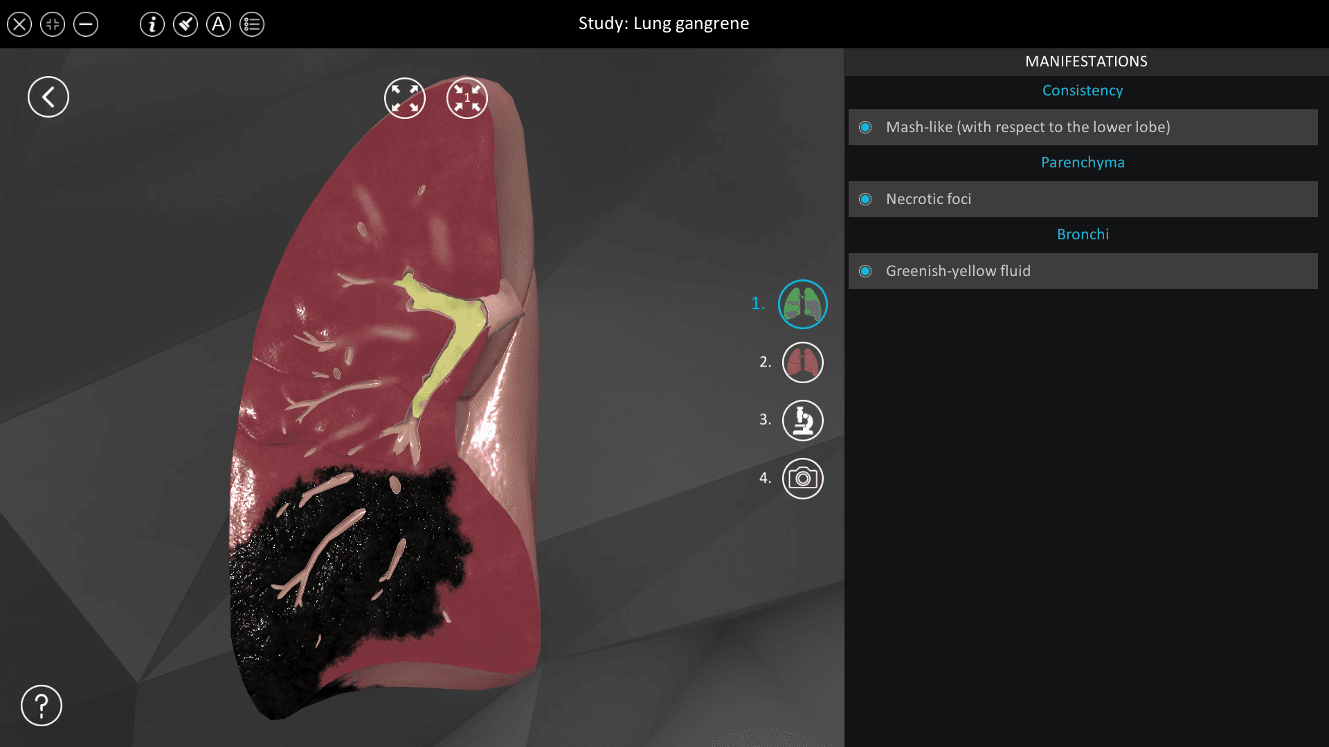 Lung gangrene