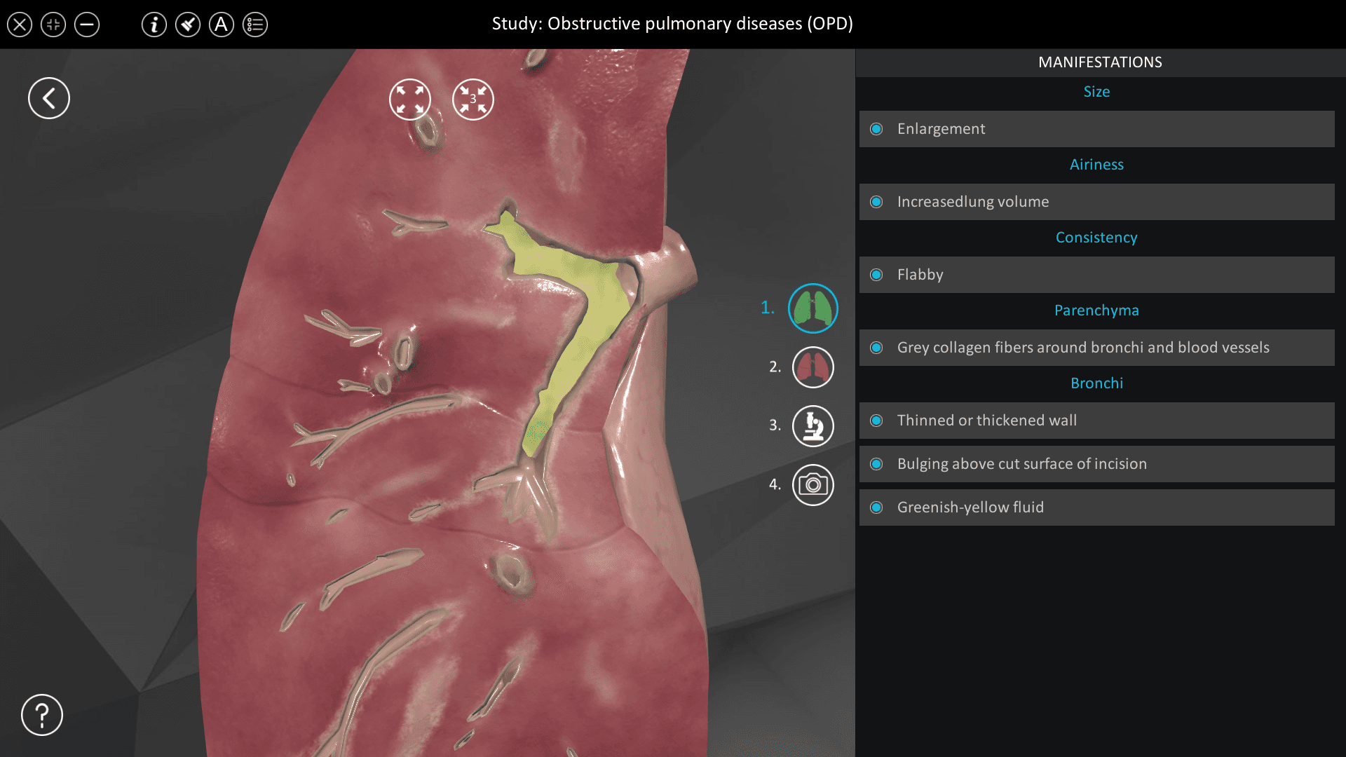 Obstructive pulmonary diseases (OPD)