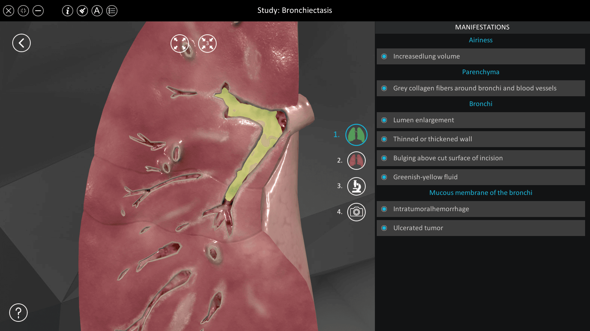 Bronchiectasis