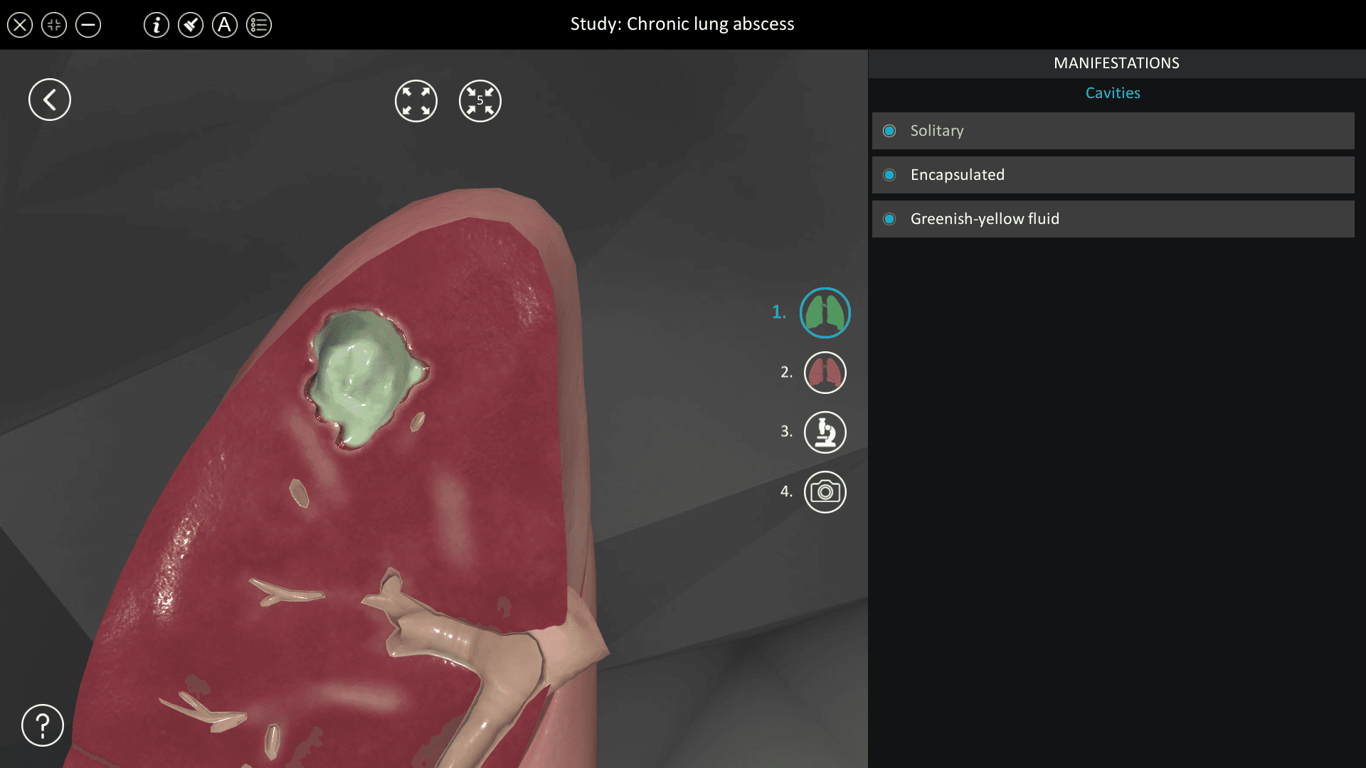 Chronic lung abscess