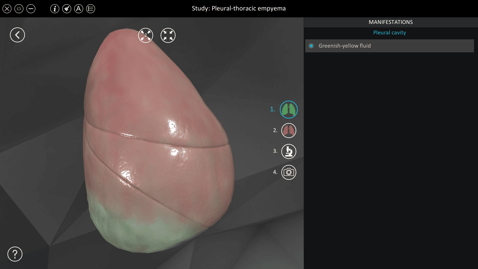 Pleural-thoracic empyema