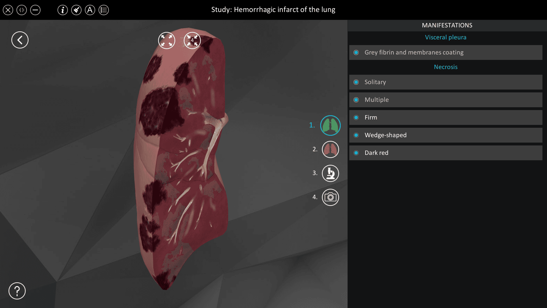 Hemorrhagic infarct of the lung
