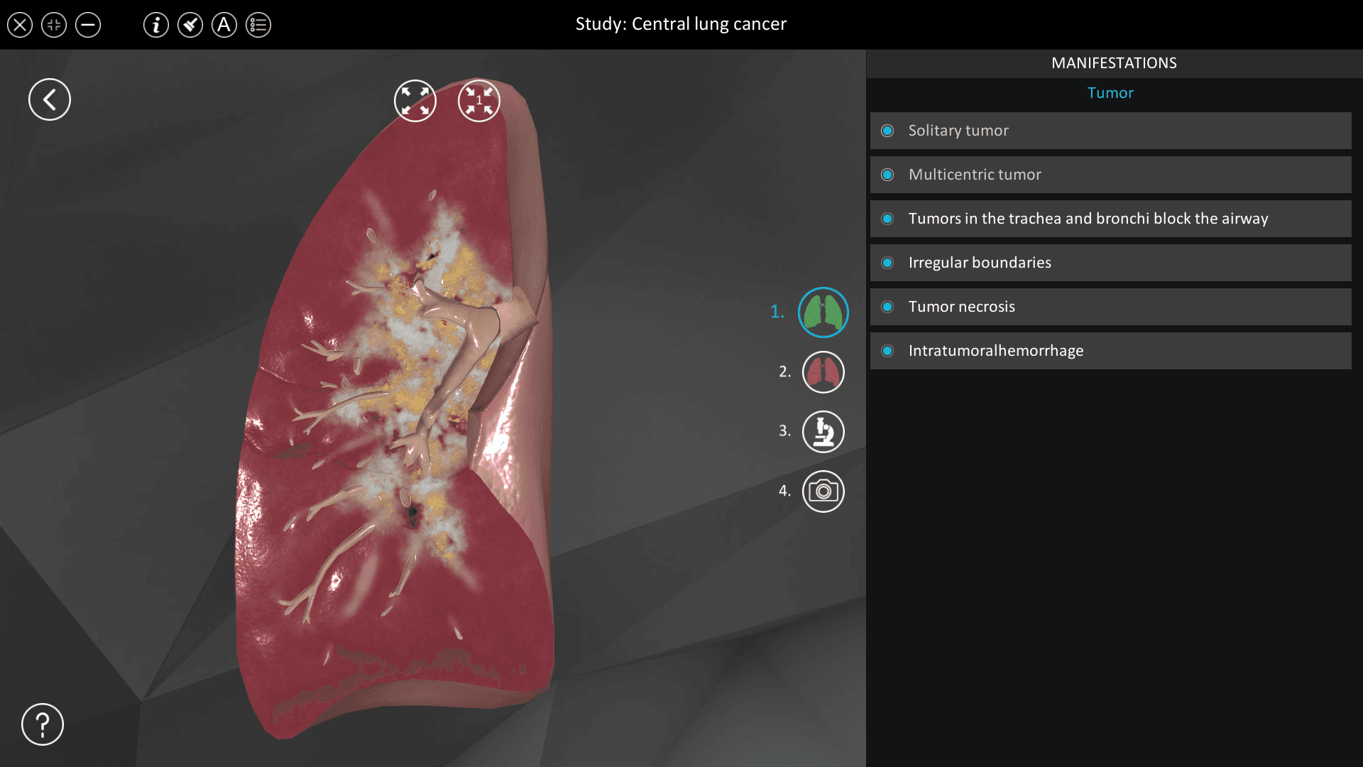 Central lung cancer