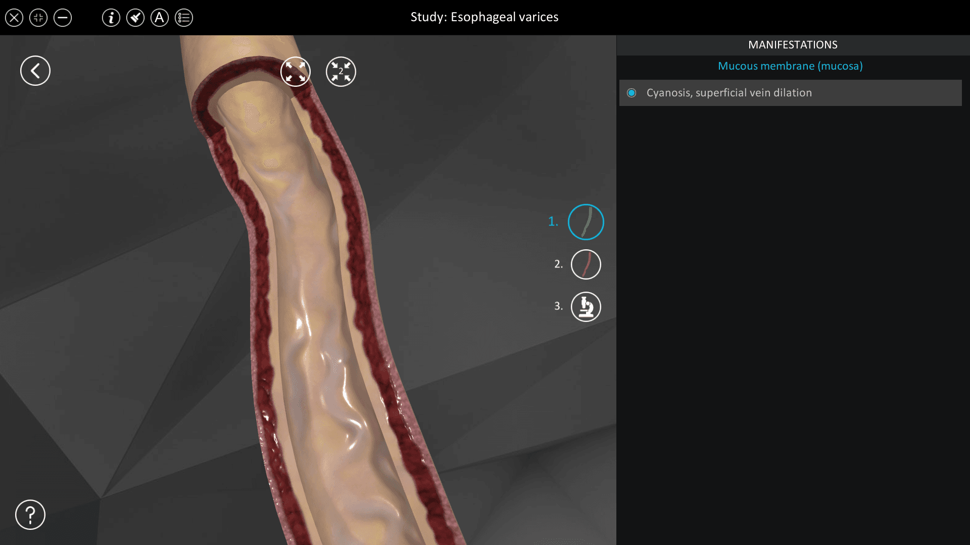 Esophageal varices