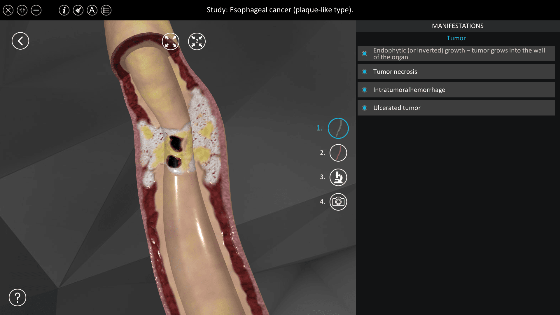 Esophageal cancer (plaque-like type)