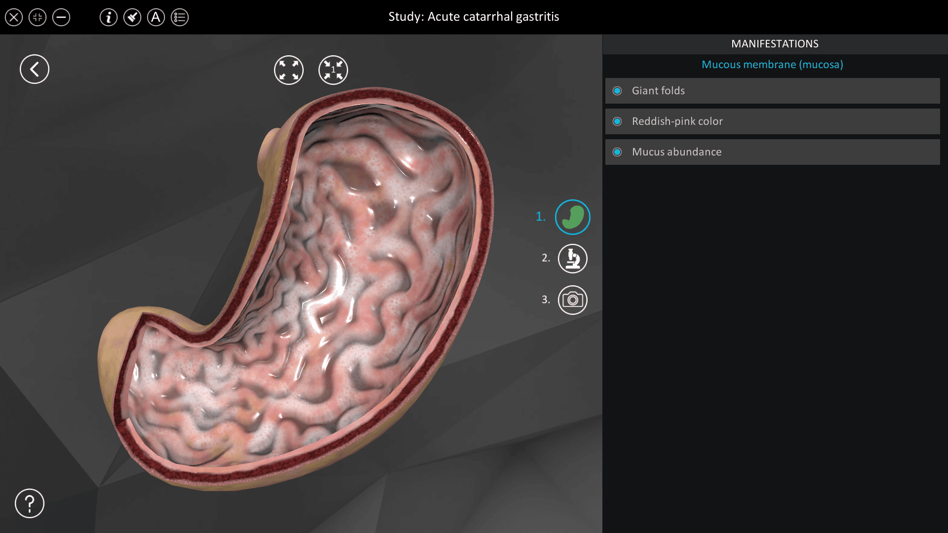 Acute catarrhal gastritis