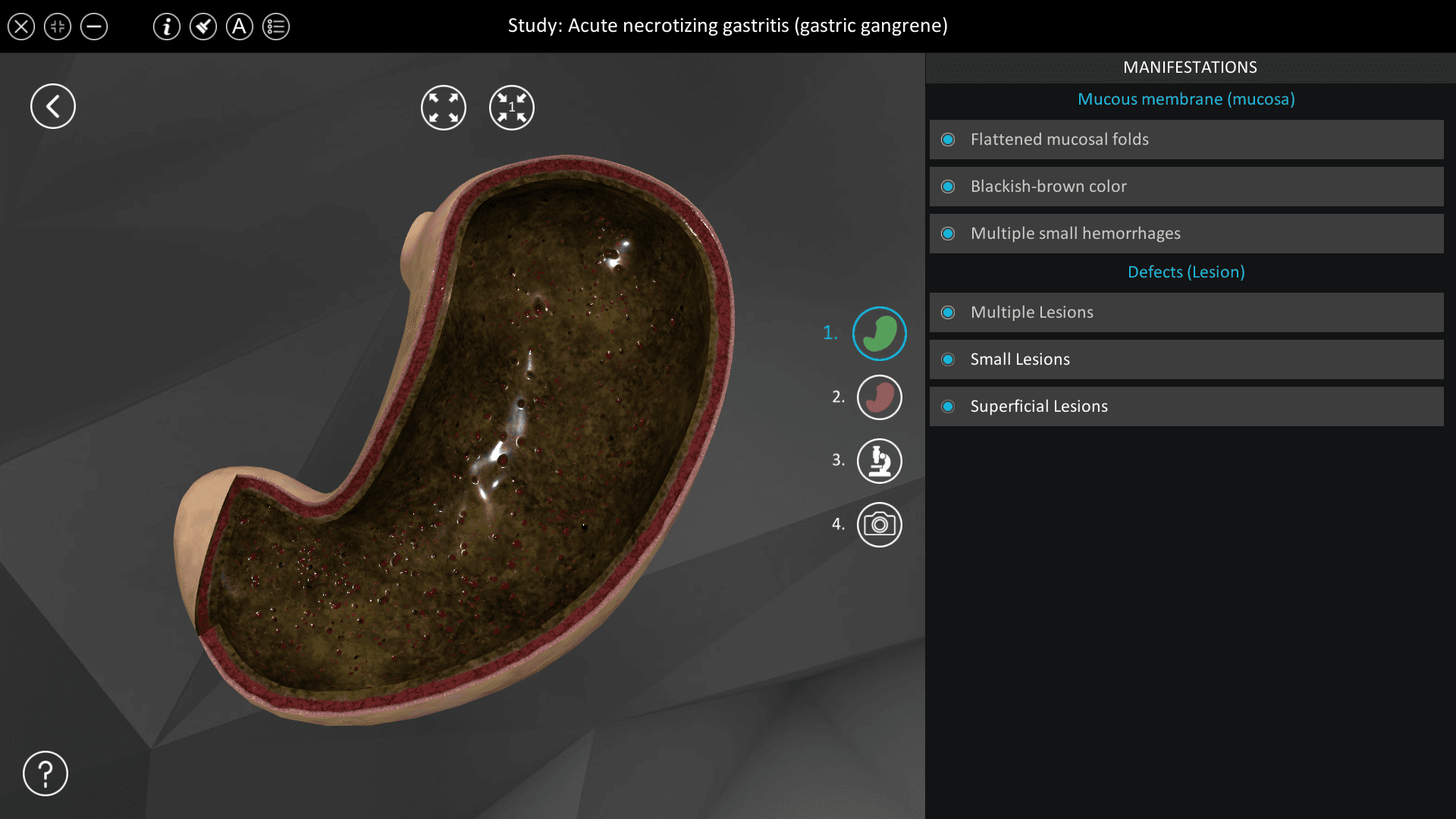 Acute necrotizing gastritis (gastric gangrene)