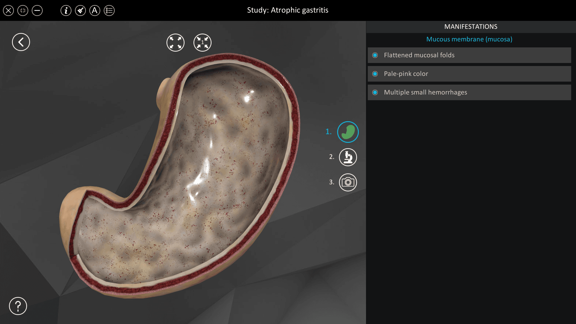 Atrophic gastritis