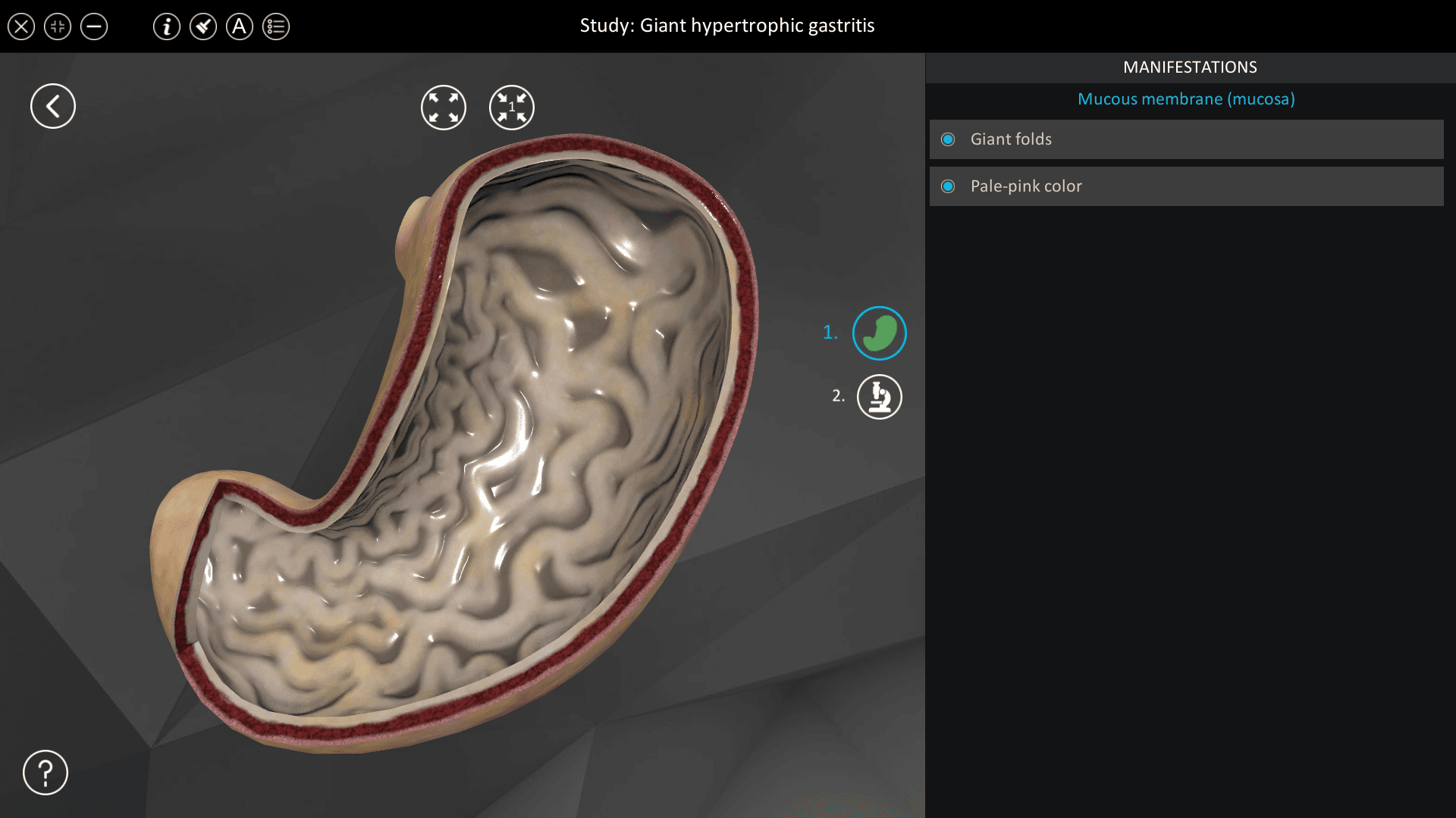 Giant hypertrophic gastritis