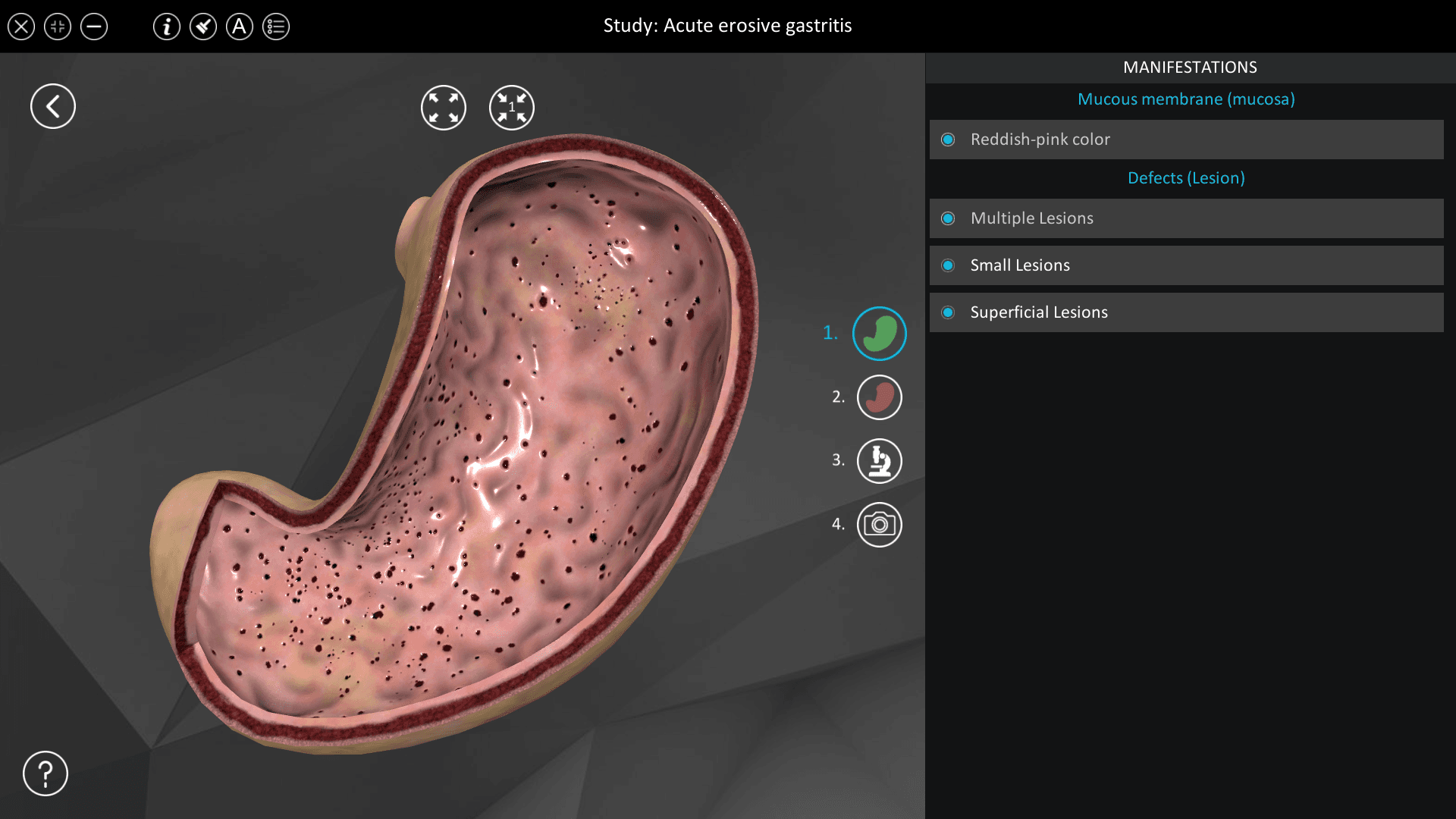 Acute erosive gastritis