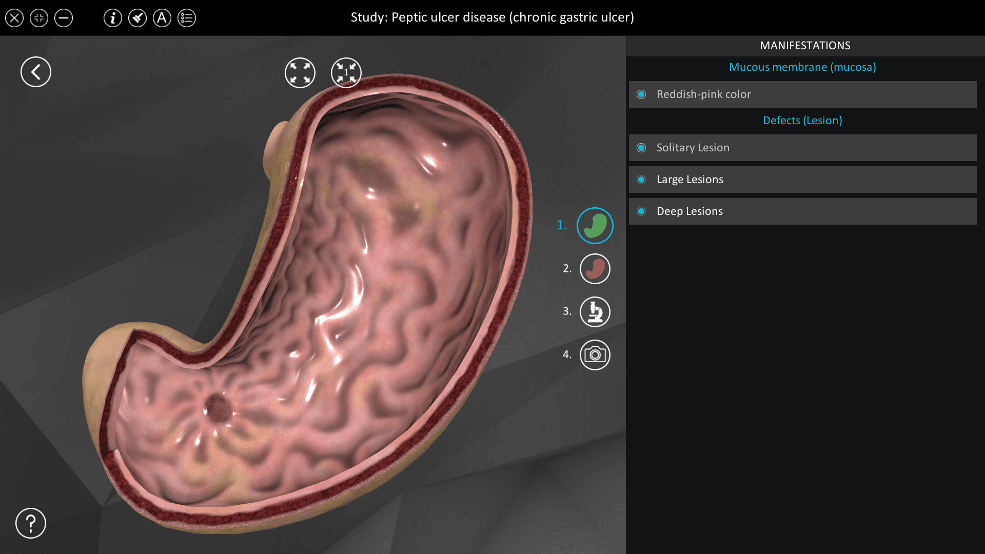 Peptic ulcer disease (chronic gastric ulcer)