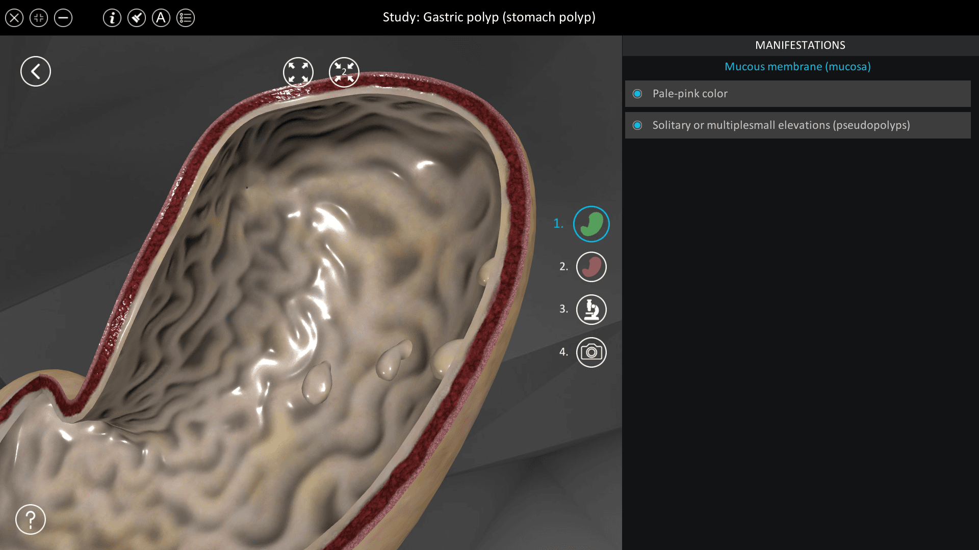 Gastric polyp (stomach polyp)