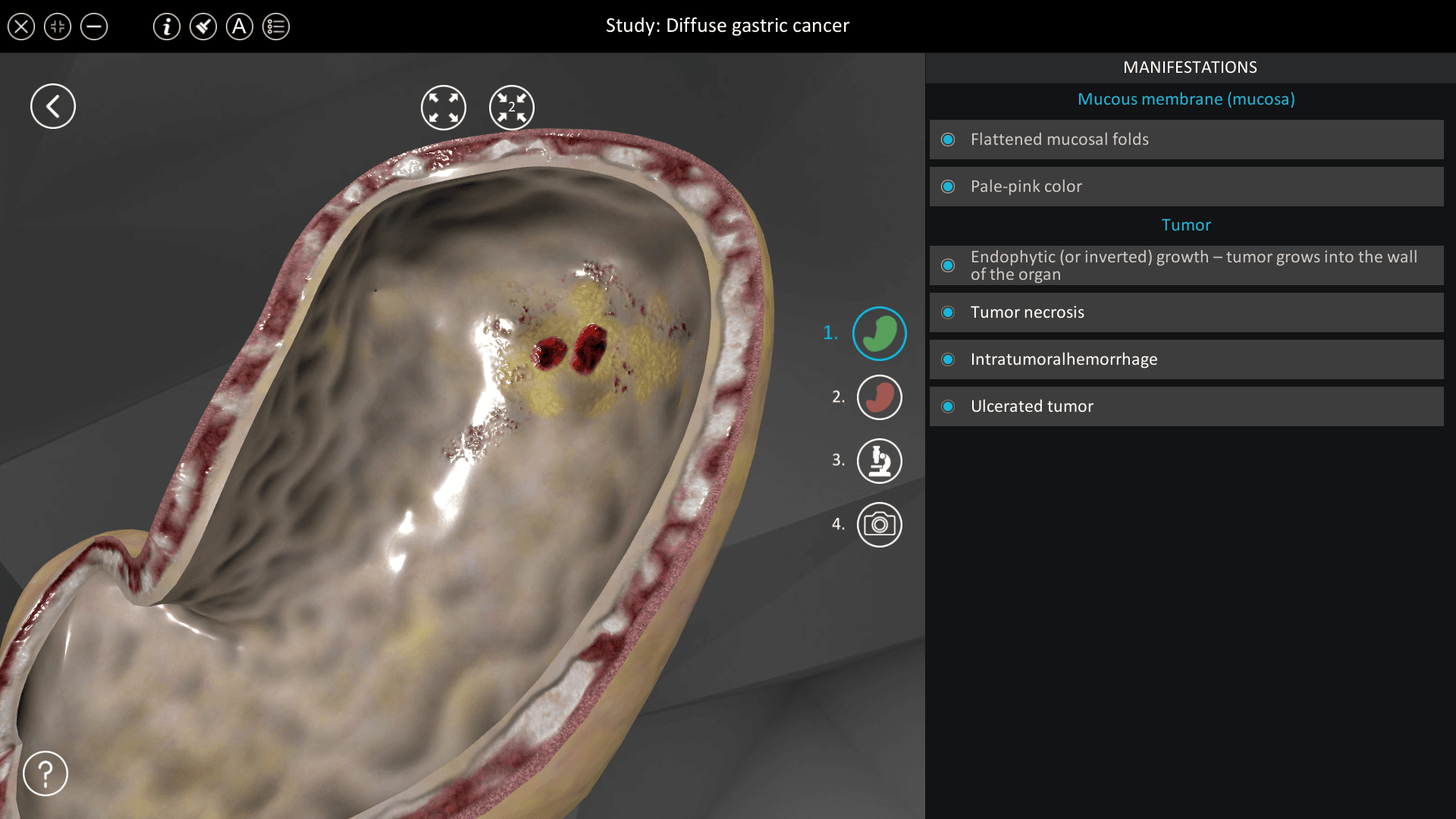 Diffuse gastric cancer
