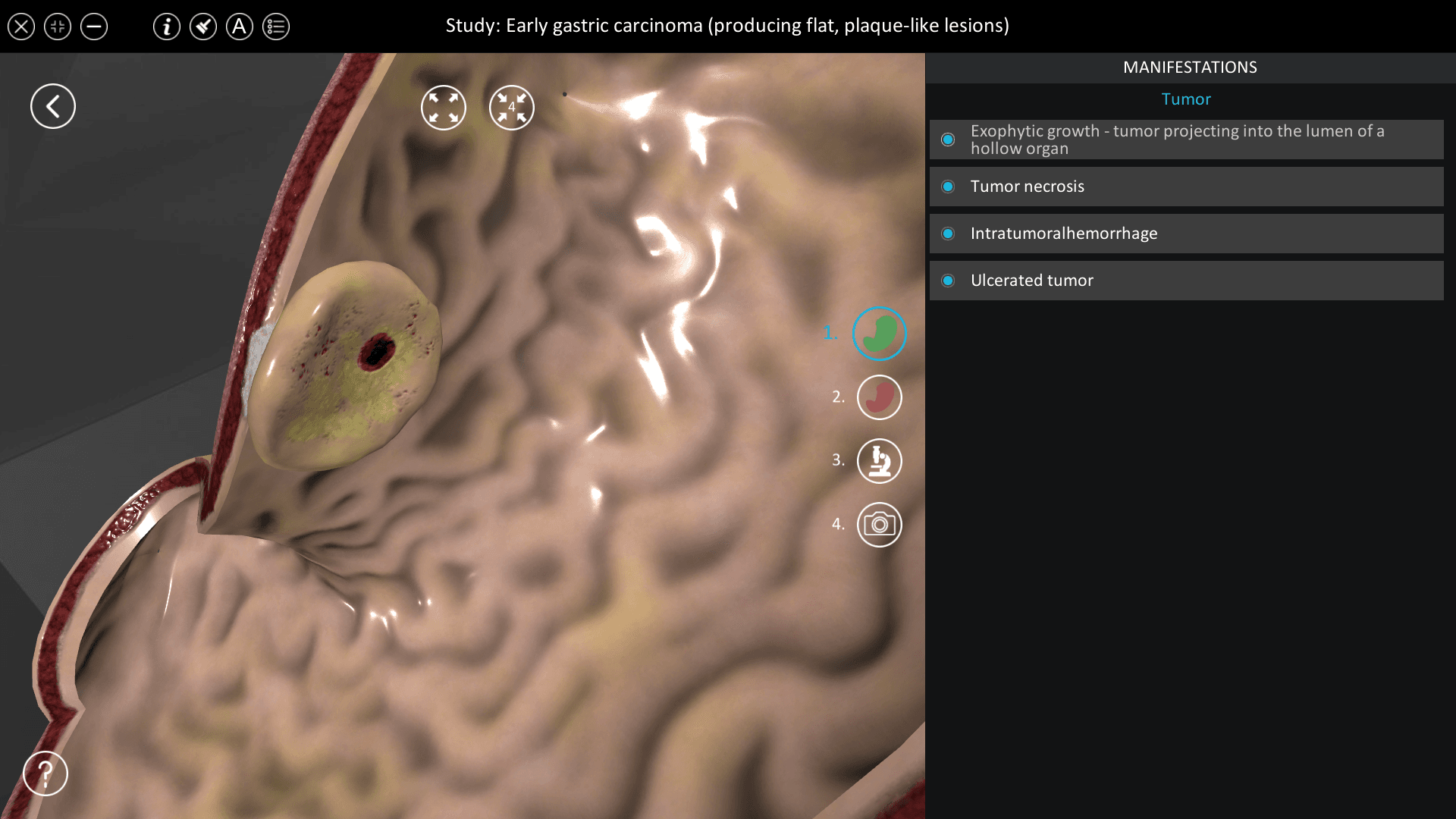 Early gastric carcinoma (producing flat, plaque-like lesions)