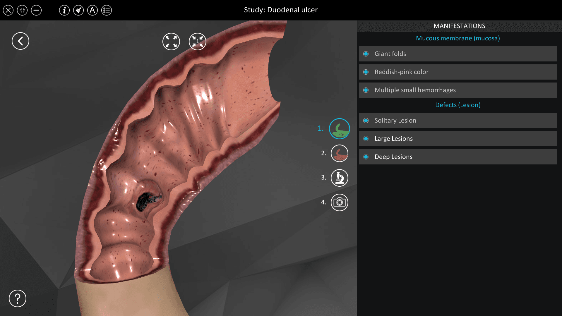 Duodenal ulcer