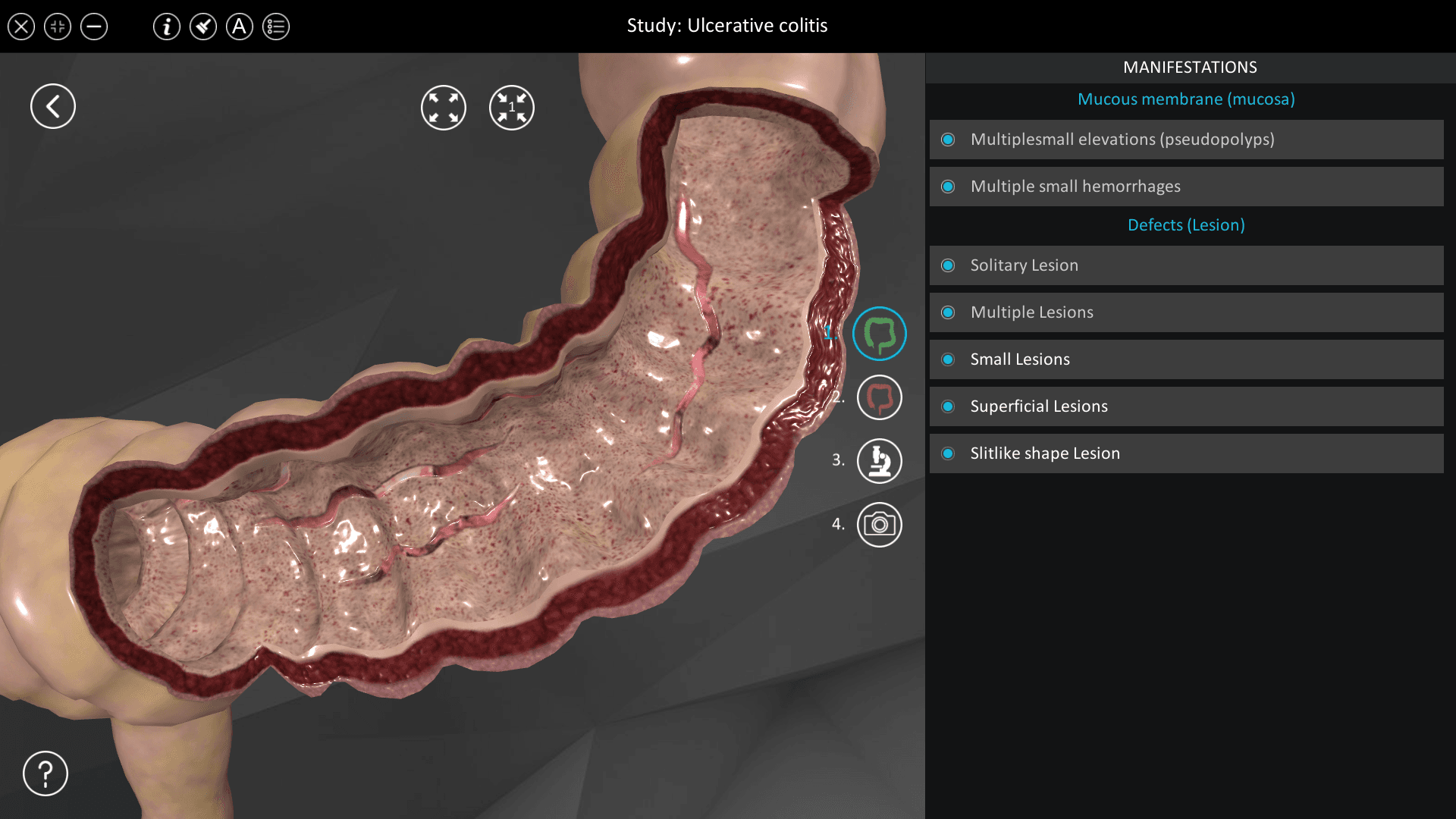 Ulcerative colitis