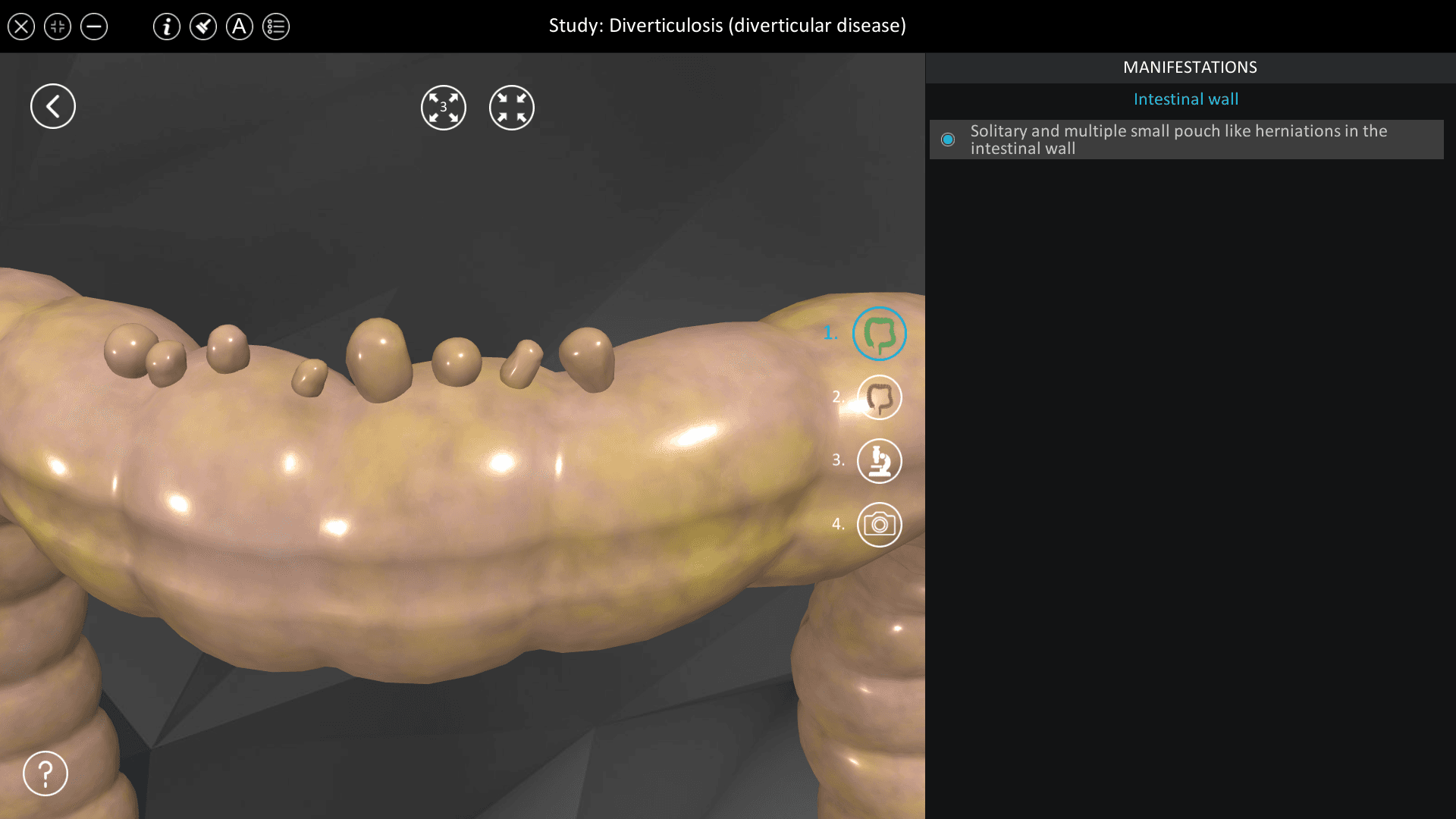 Diverticulosis (diverticular disease)