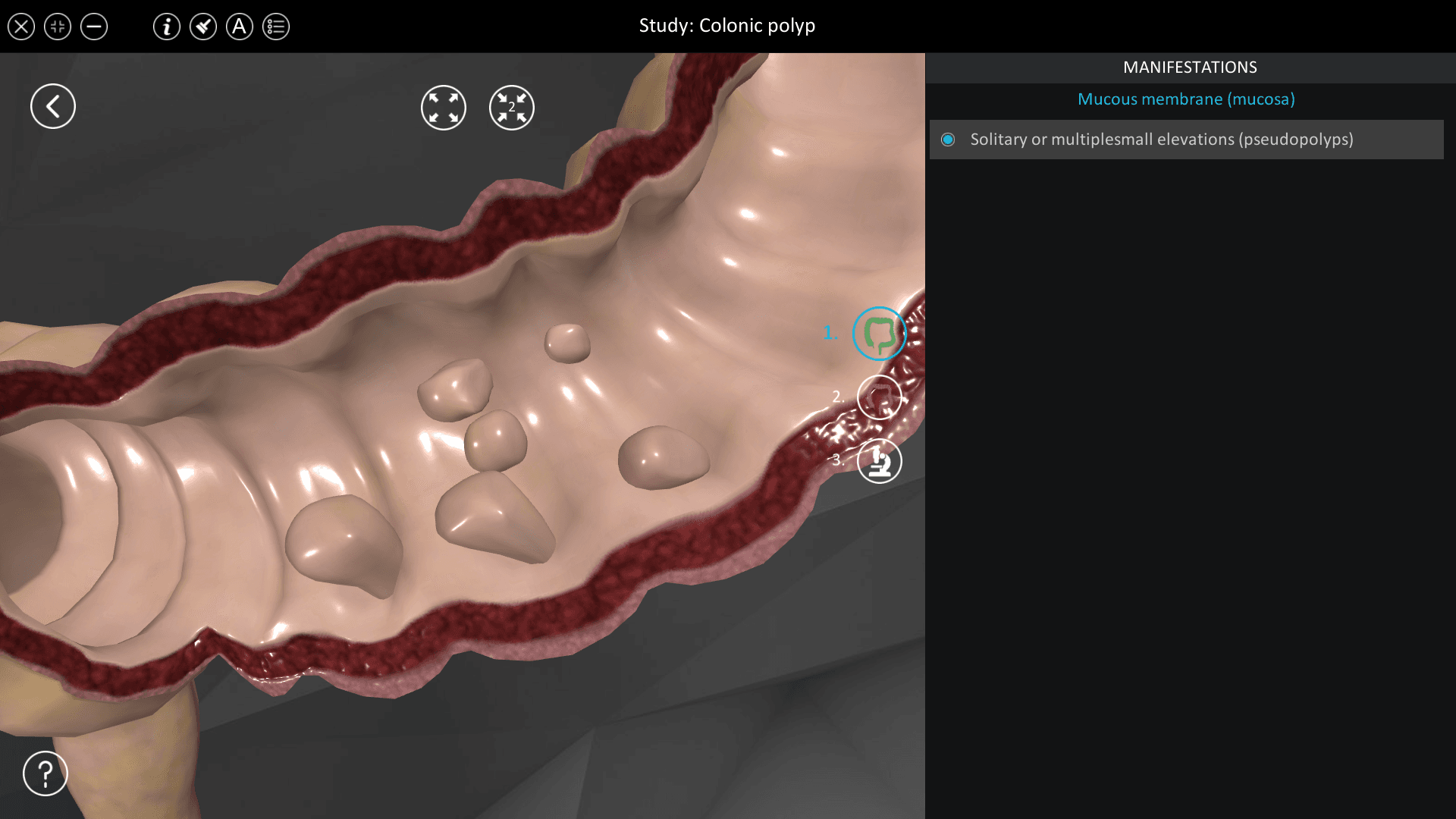 Colonic polyp