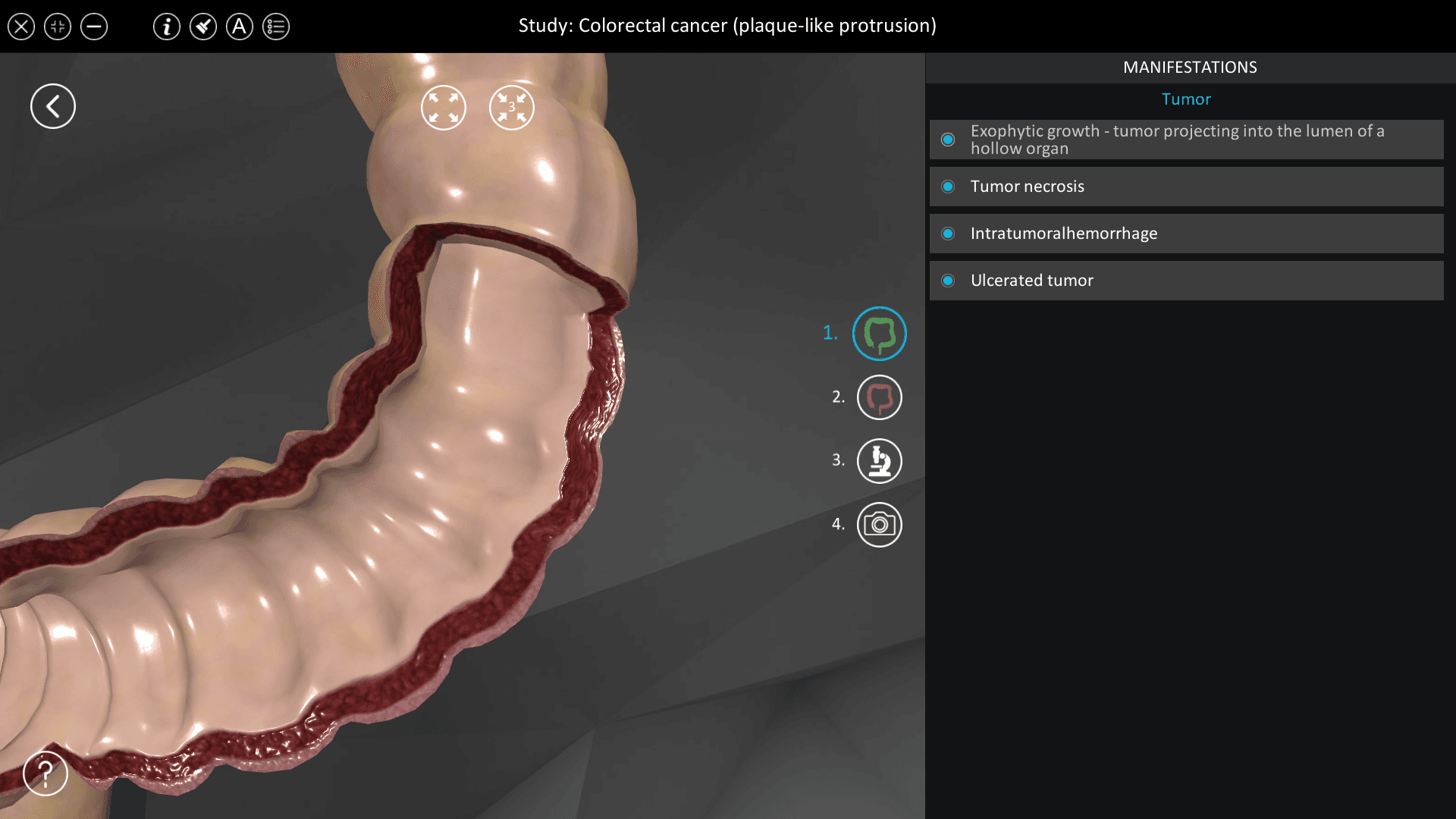 Colorectal cancer (plaque-like protrusion)