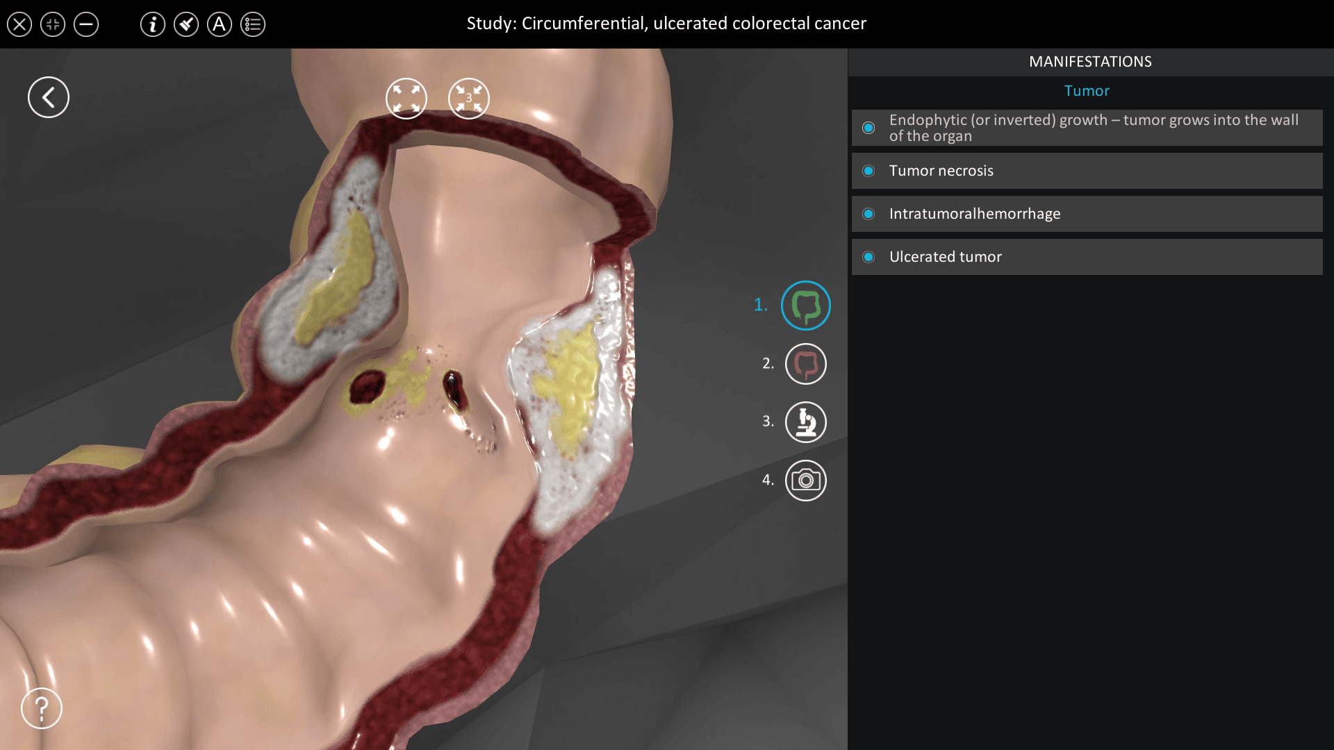 Circumferential, ulcerated colorectal cancer