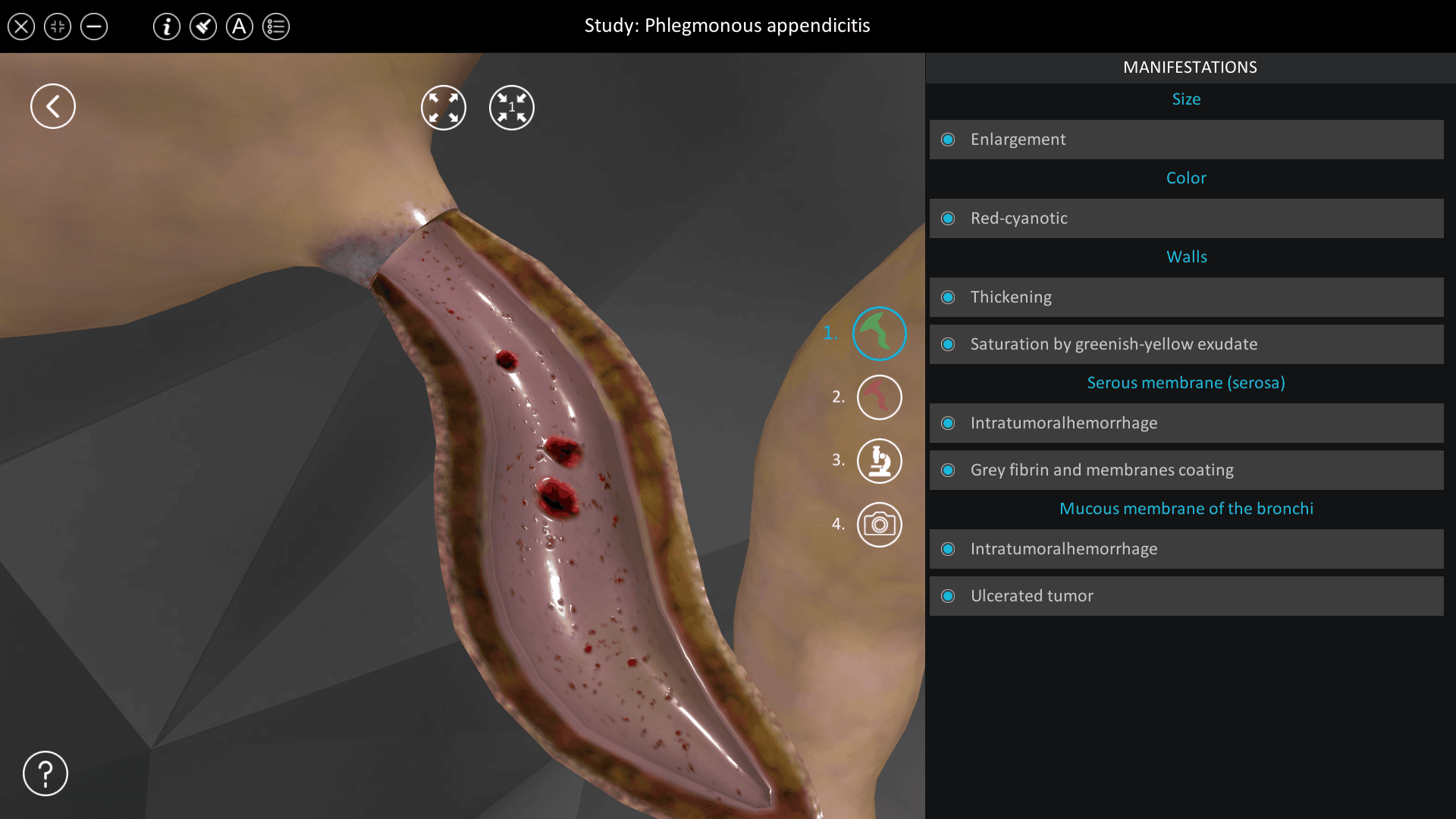 Phlegmonous appendicitis