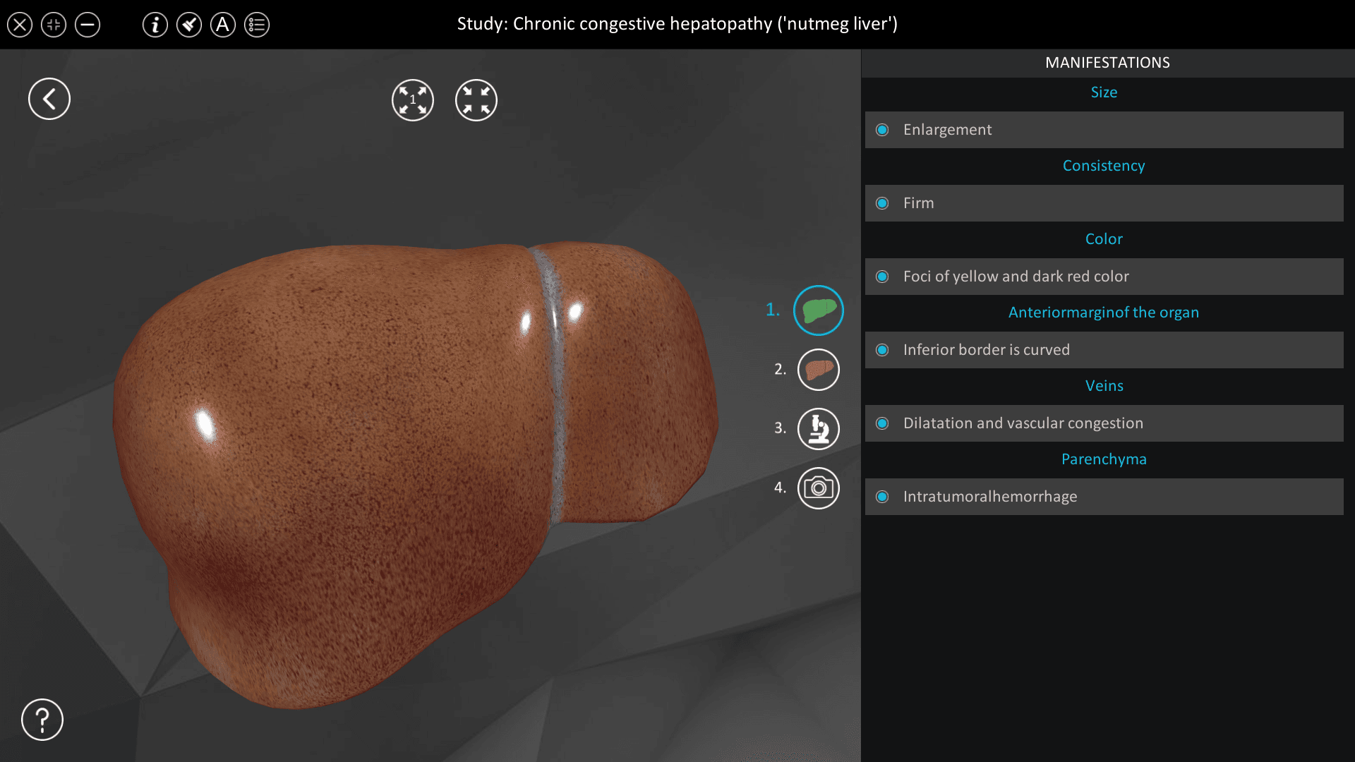 Chronic congestive hepatopathy (“nutmeg liver”)