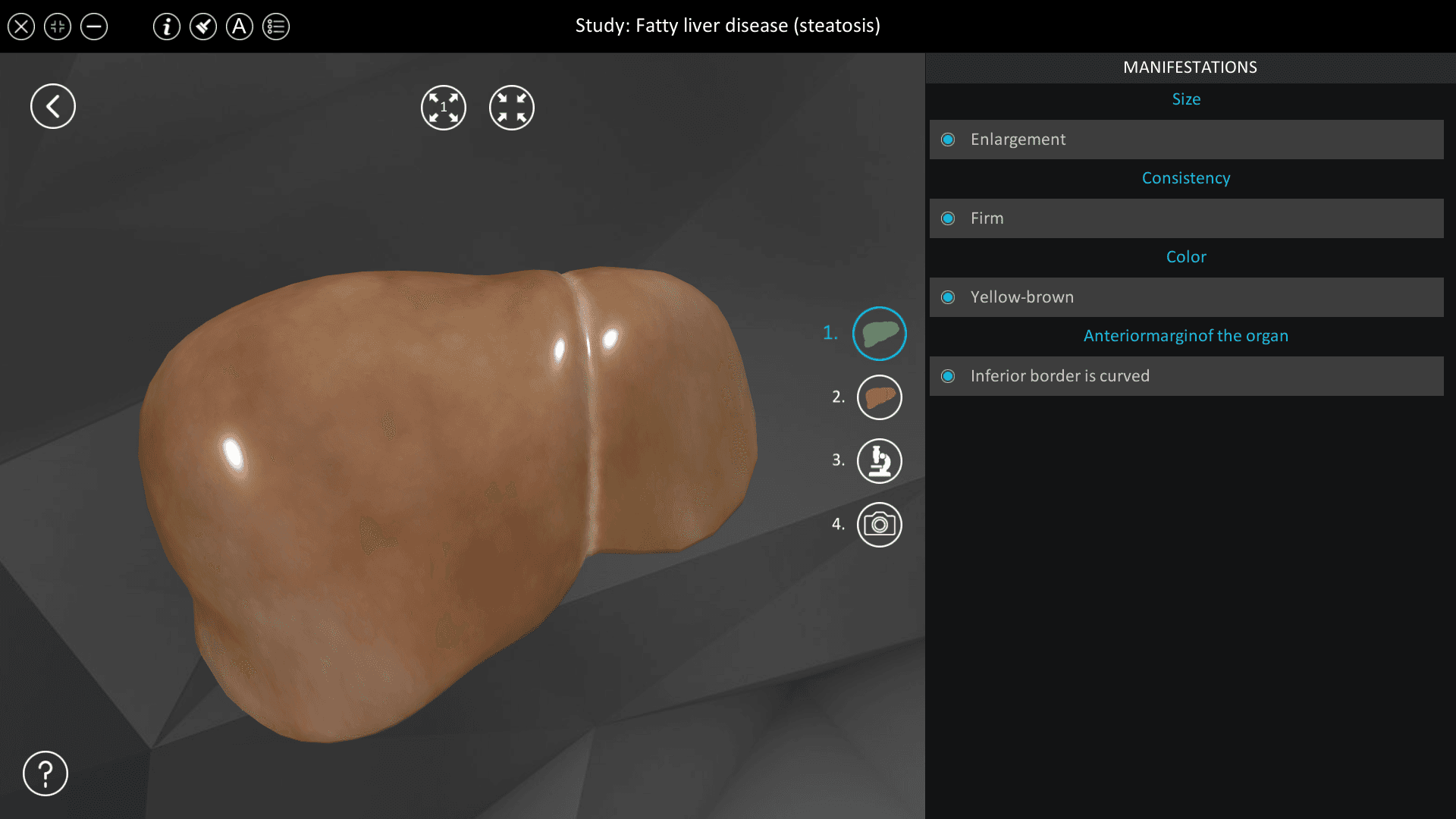 Fatty liver disease (steatosis)