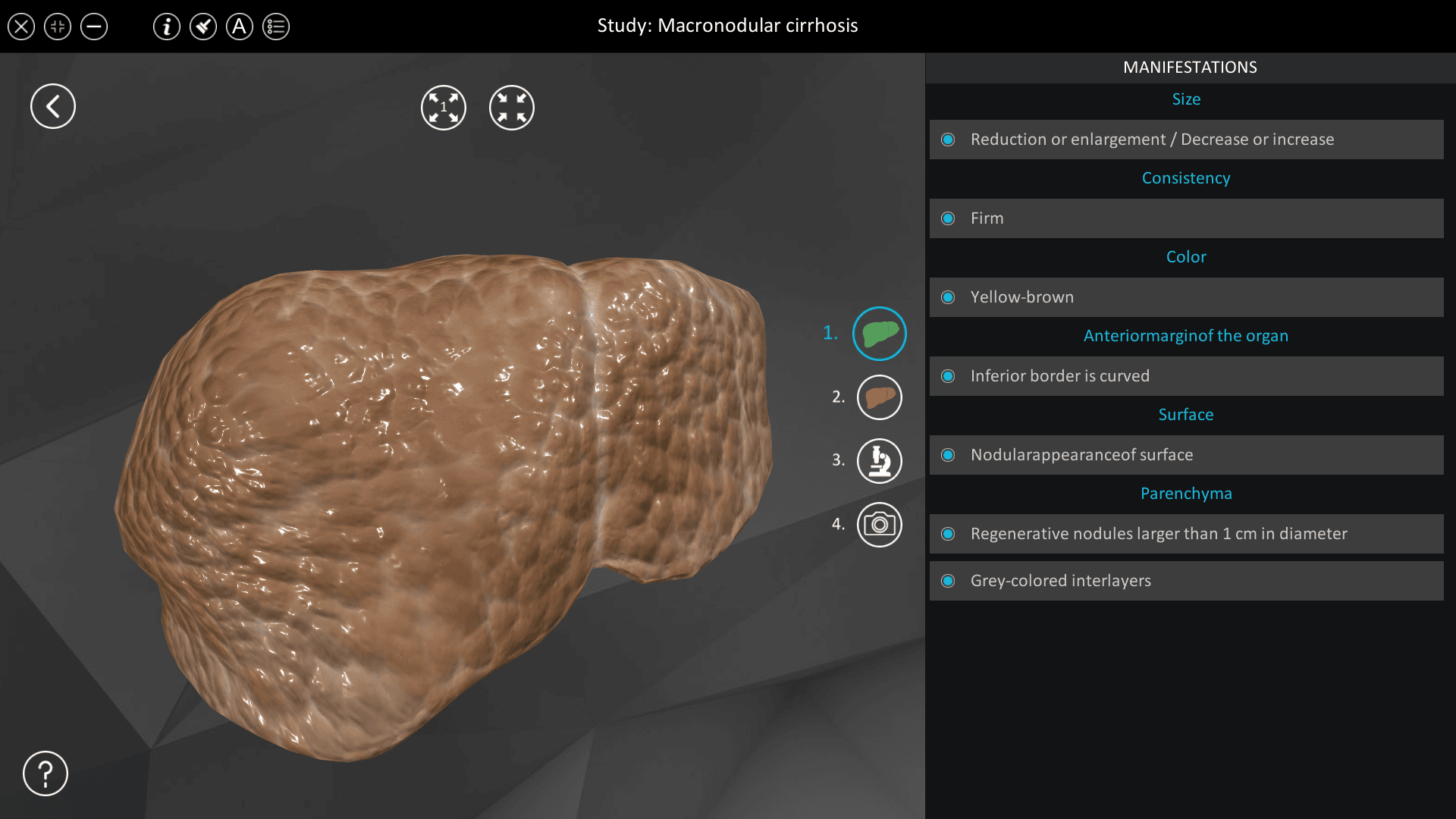 Macronodular cirrhosis