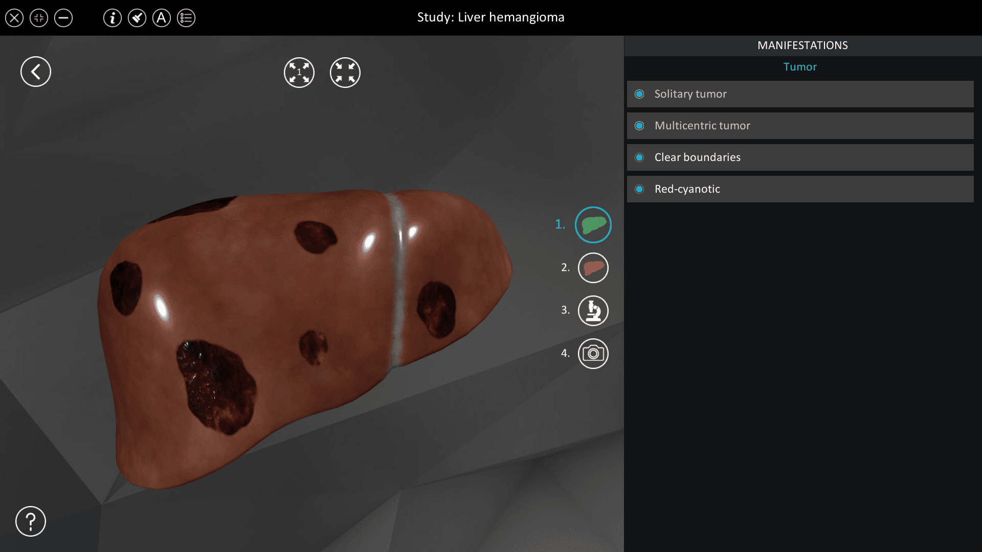 Liver hemangioma