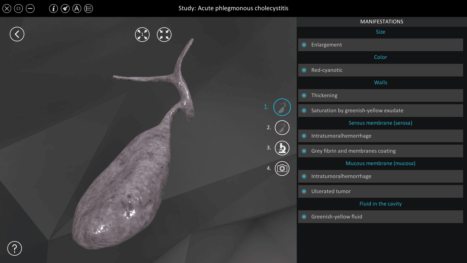 Acute phlegmonous cholecystitis