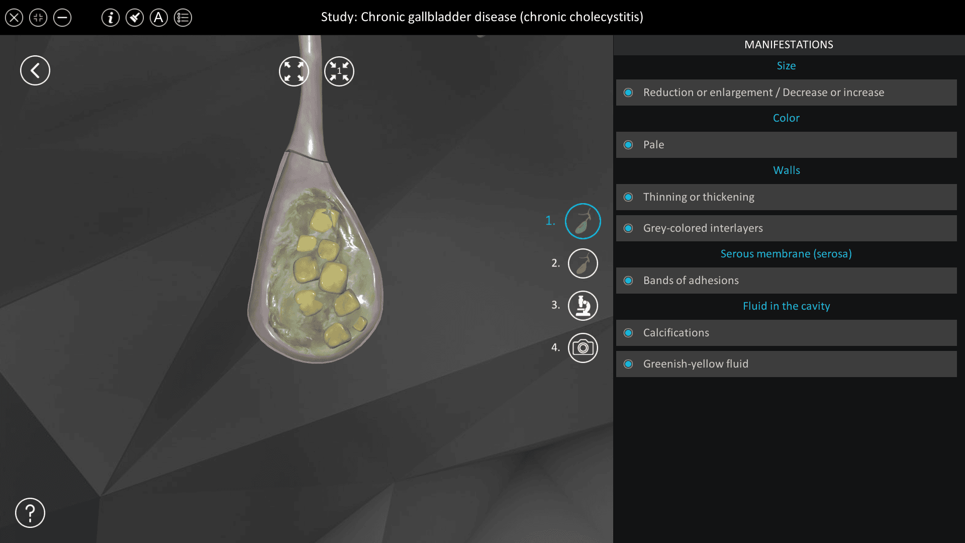 Chronic gallbladder disease (chronic cholecystitis)