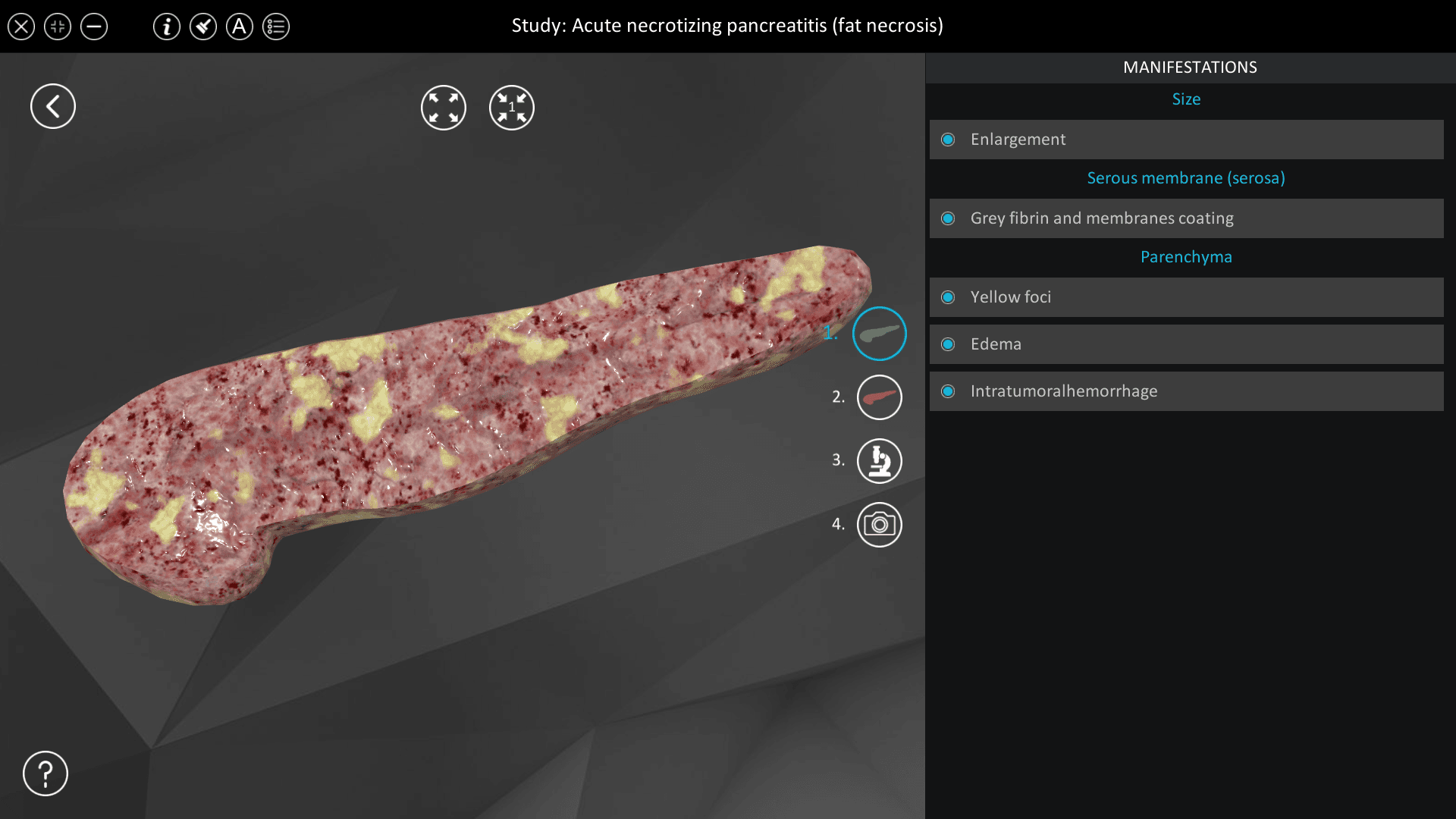 Acute necrotizing pancreatitis (fat necrosis)