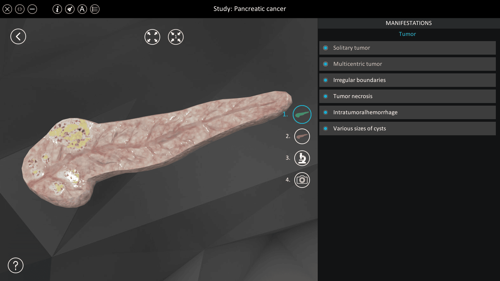 Pancreatic cancer
