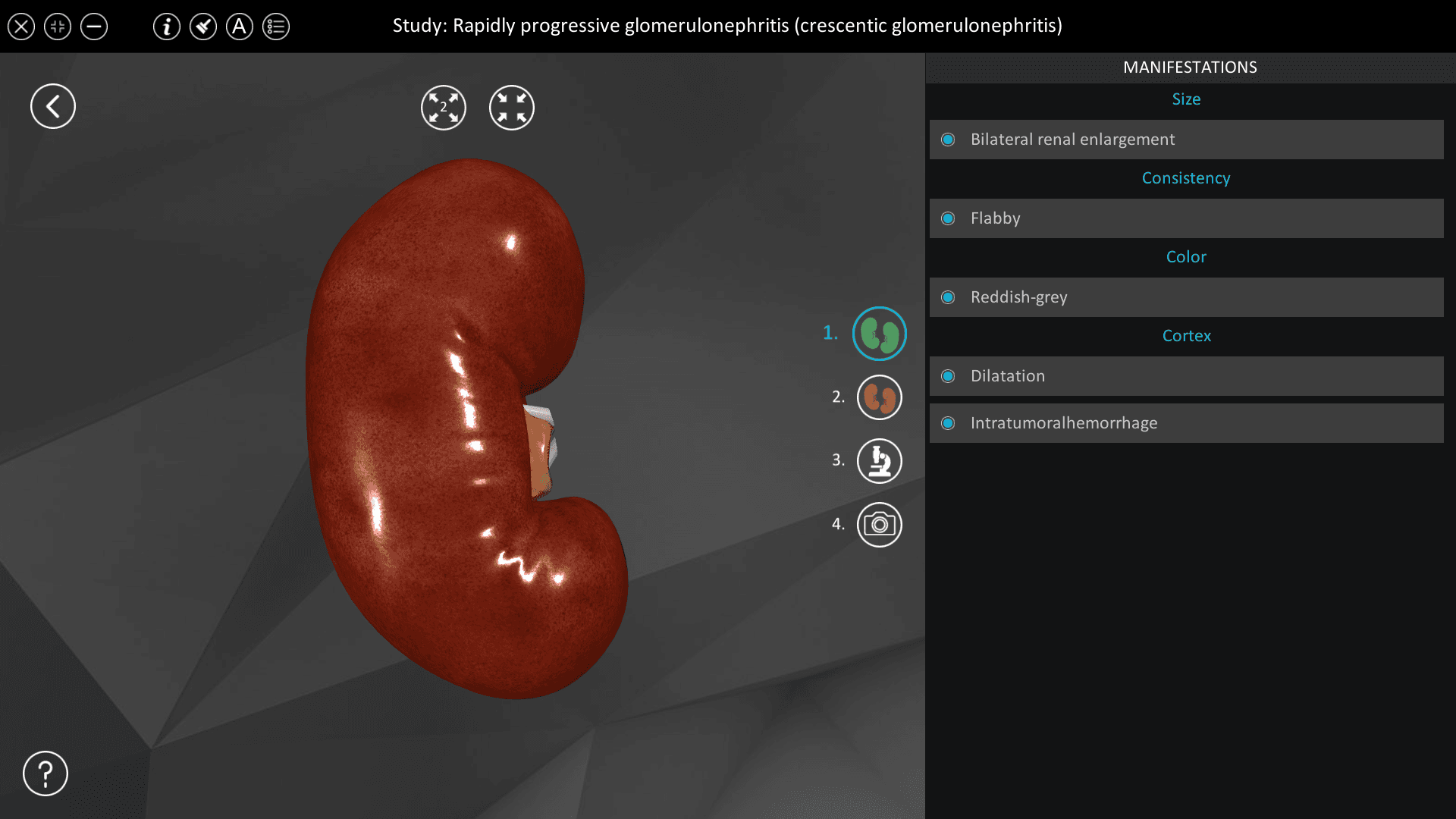 Rapidly progressive glomerulonephritis