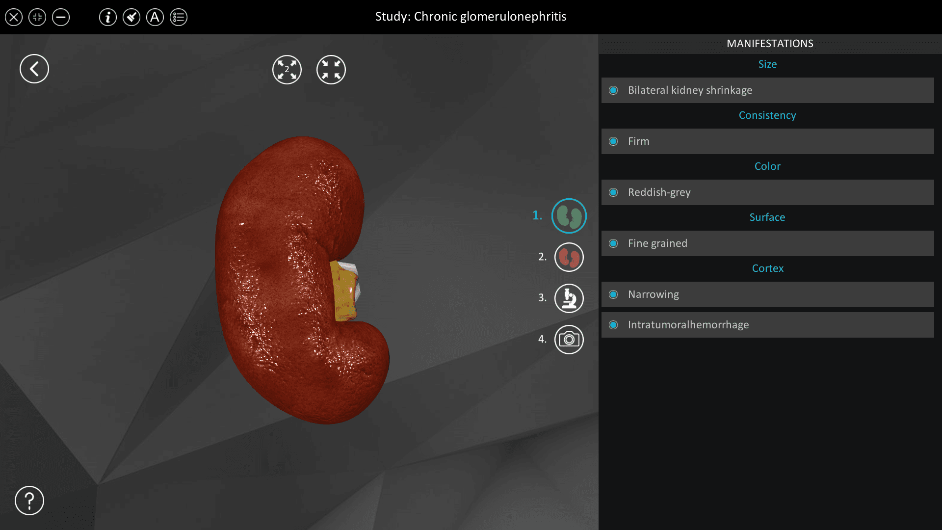 Chronic glomerulonephritis