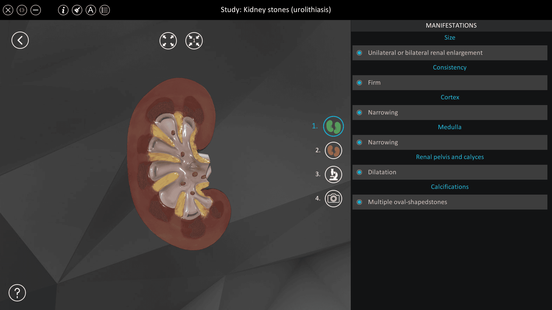 Kidney stones (urolithiasis)