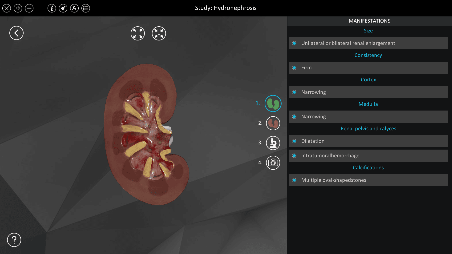 Hydronephrosis