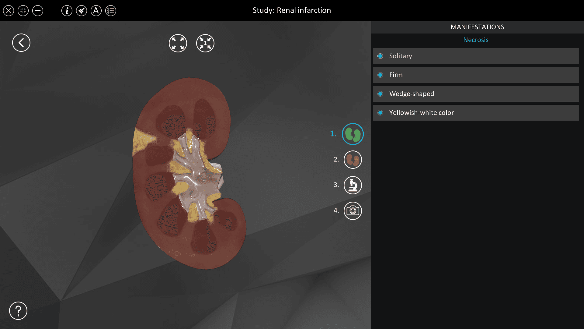Renal infarction