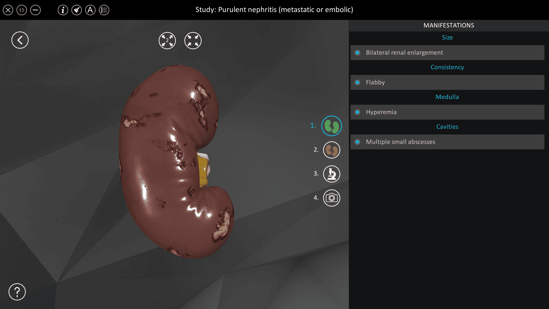 Purulent nephritis (metastatic or embolic)