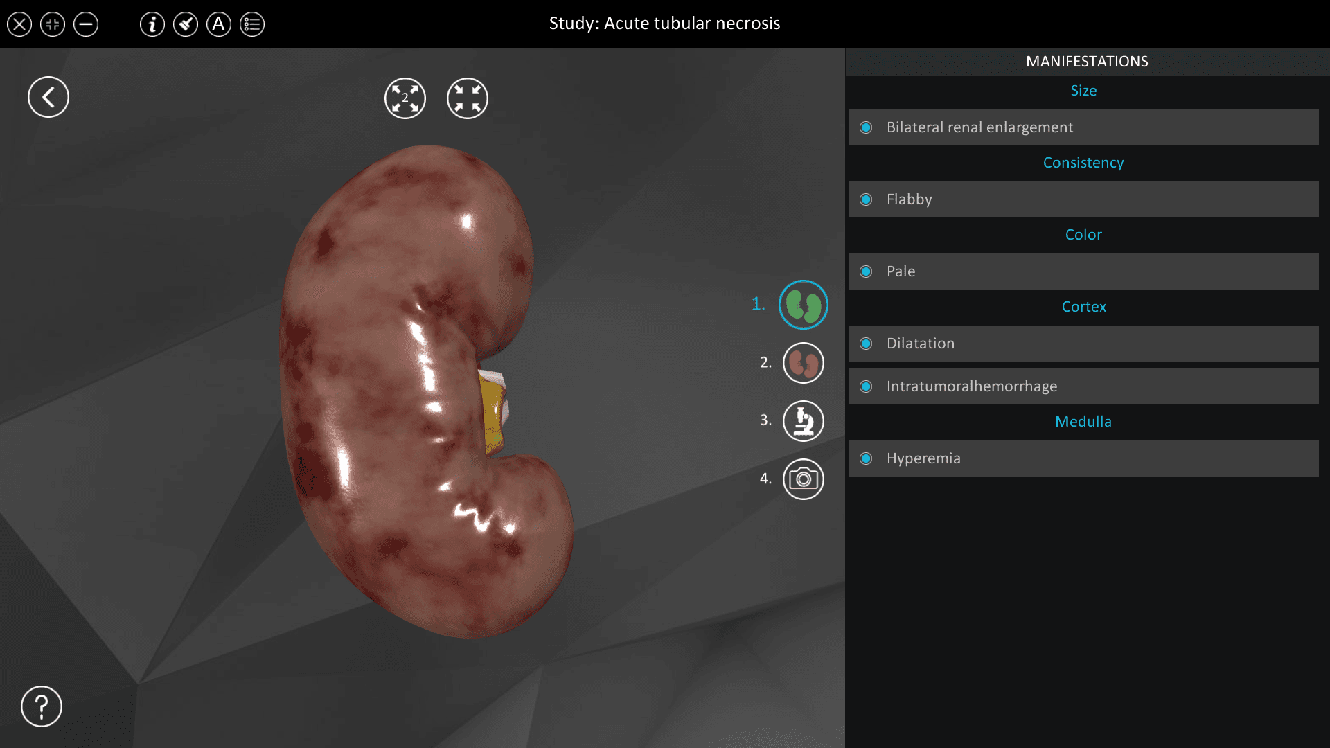 Acute tubular necrosis