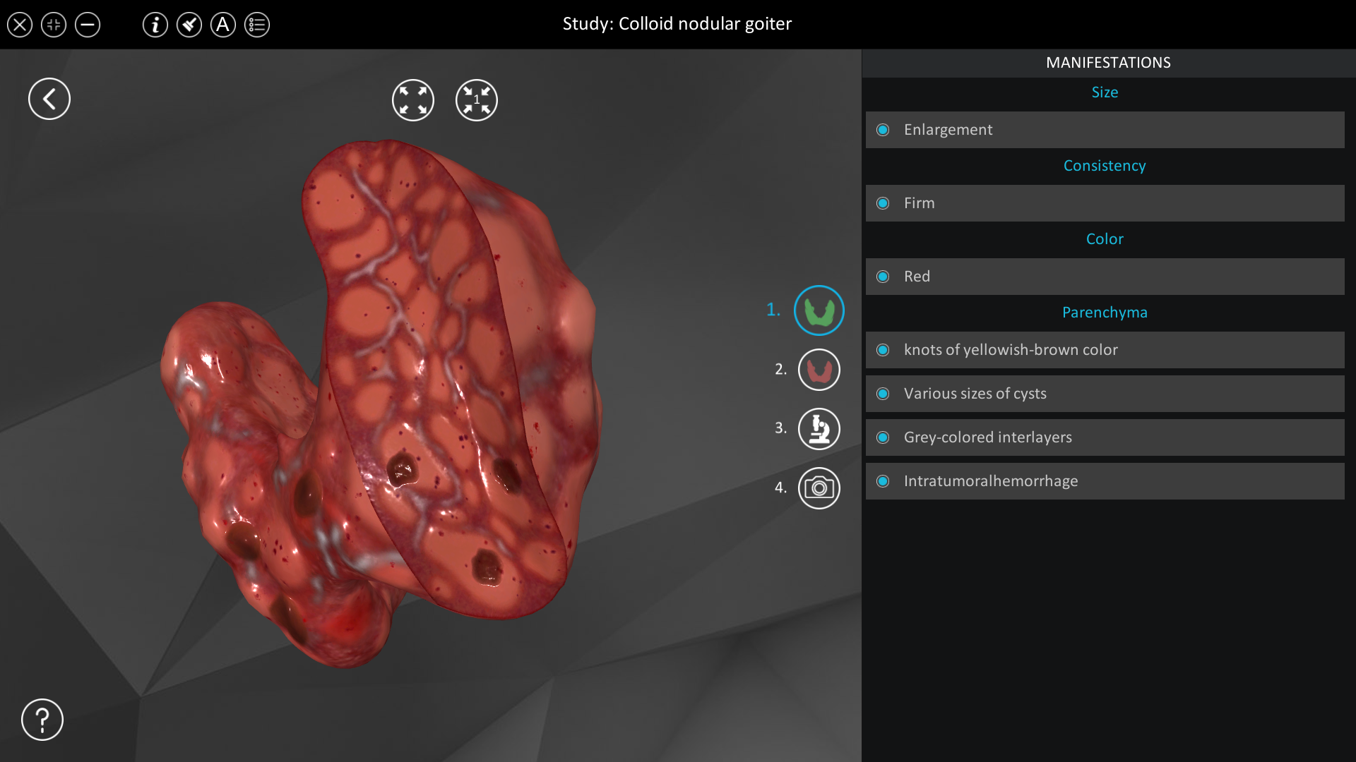 colloid goiter icd 10 code