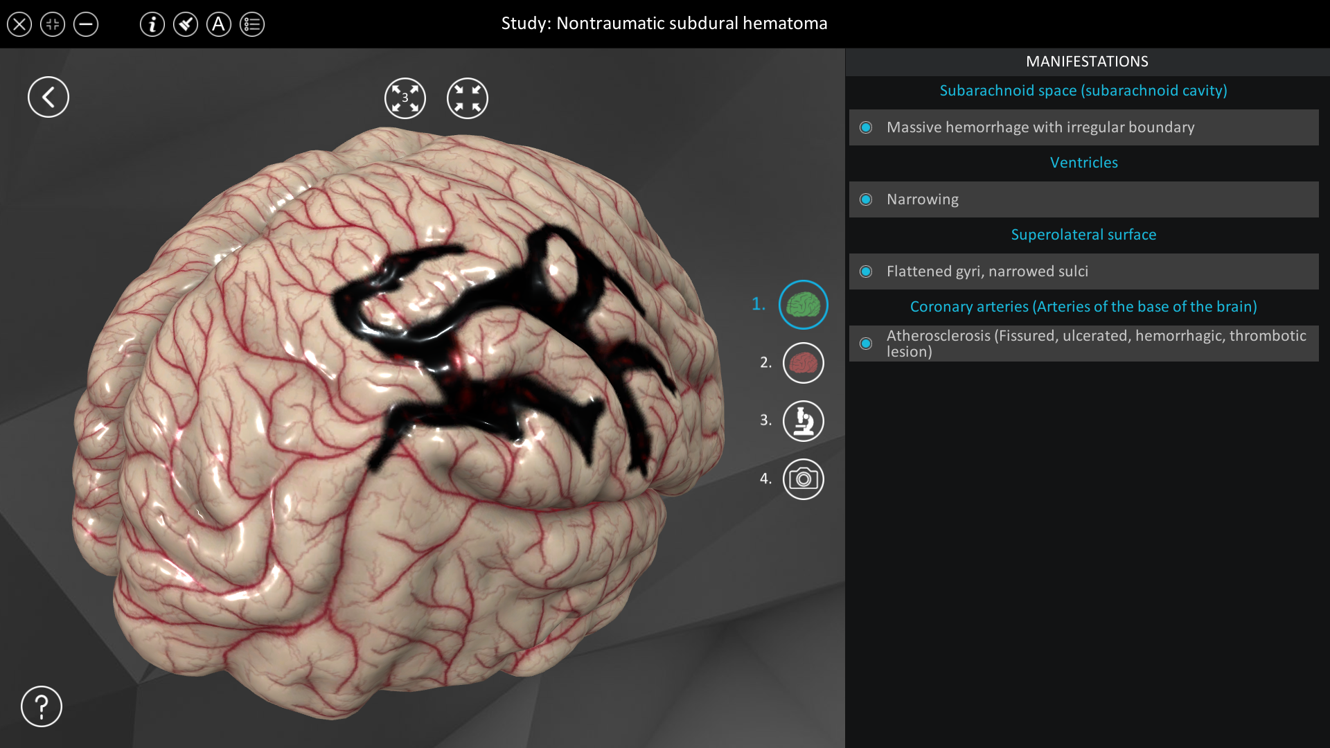 non traumatic bilateral subdural hematoma icd 10