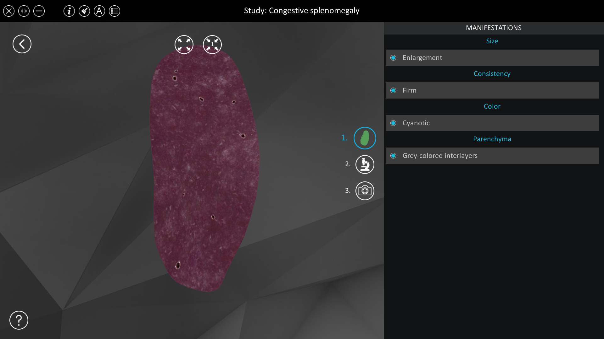 Congestive splenomegaly | ROQED