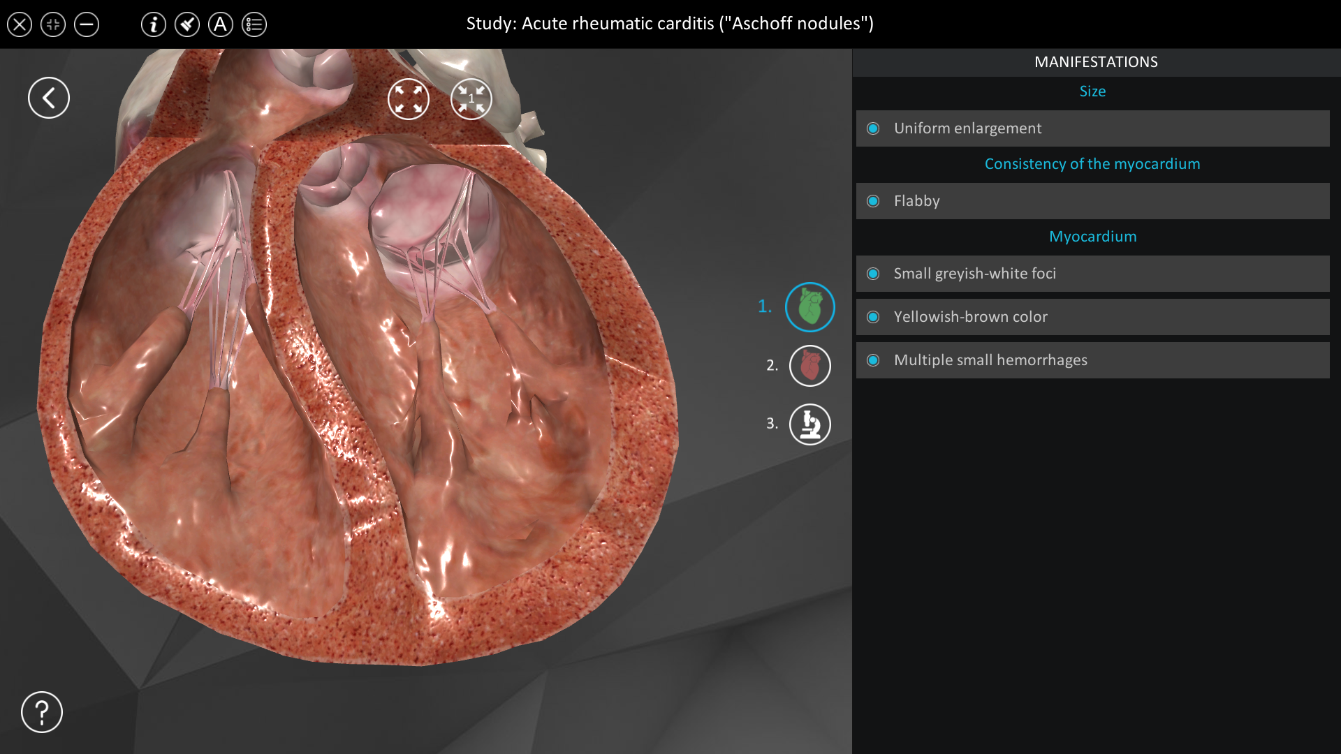 Acute rheumatic carditis (