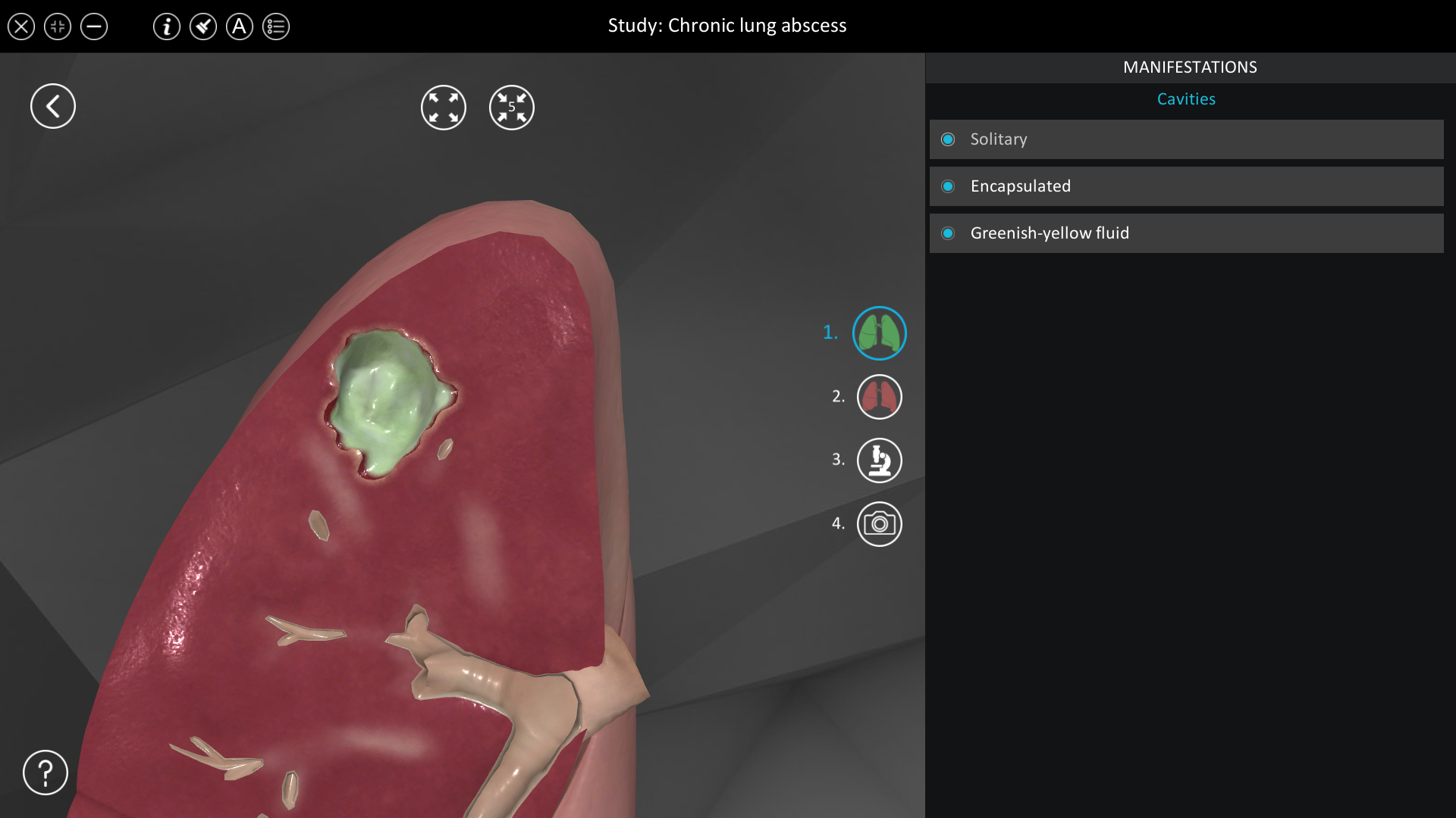 Chronic lung abscess | ROQED