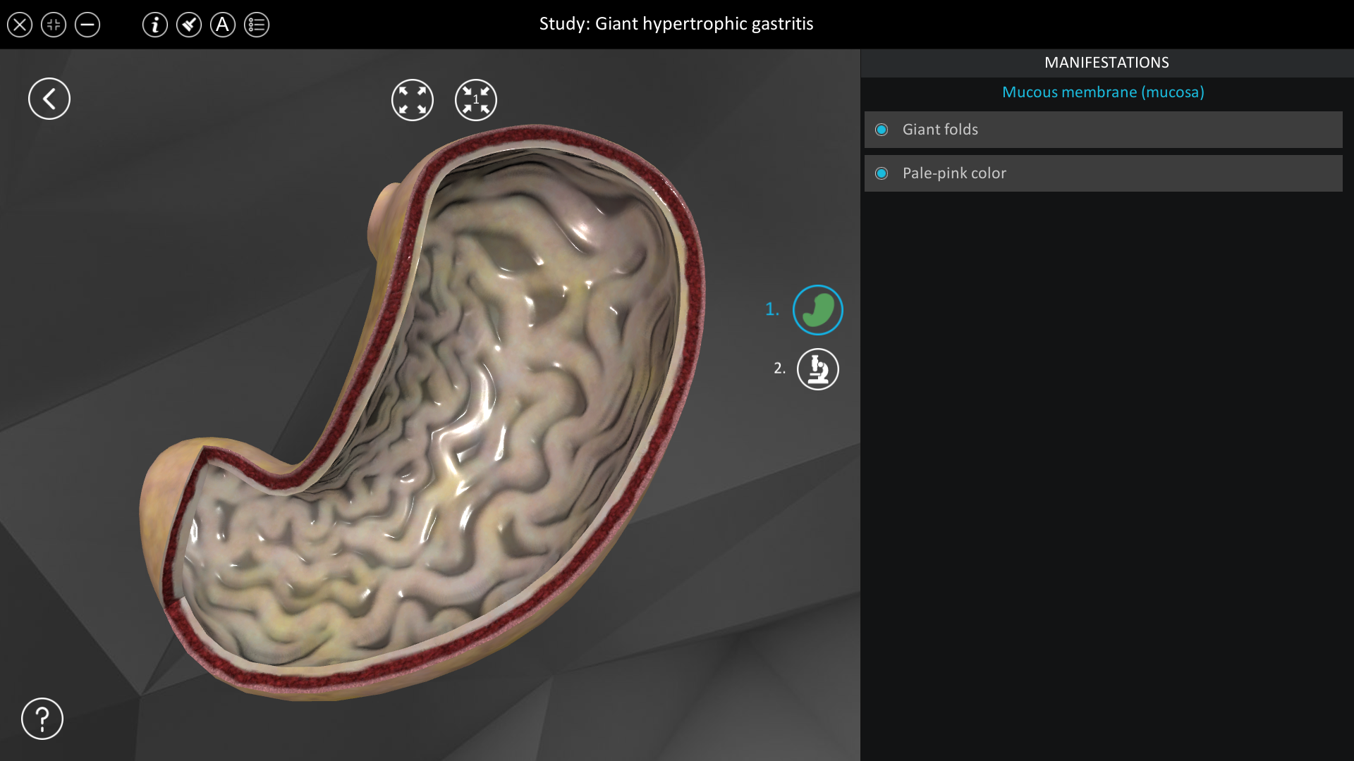 giant-hypertrophic-gastritis-roqed