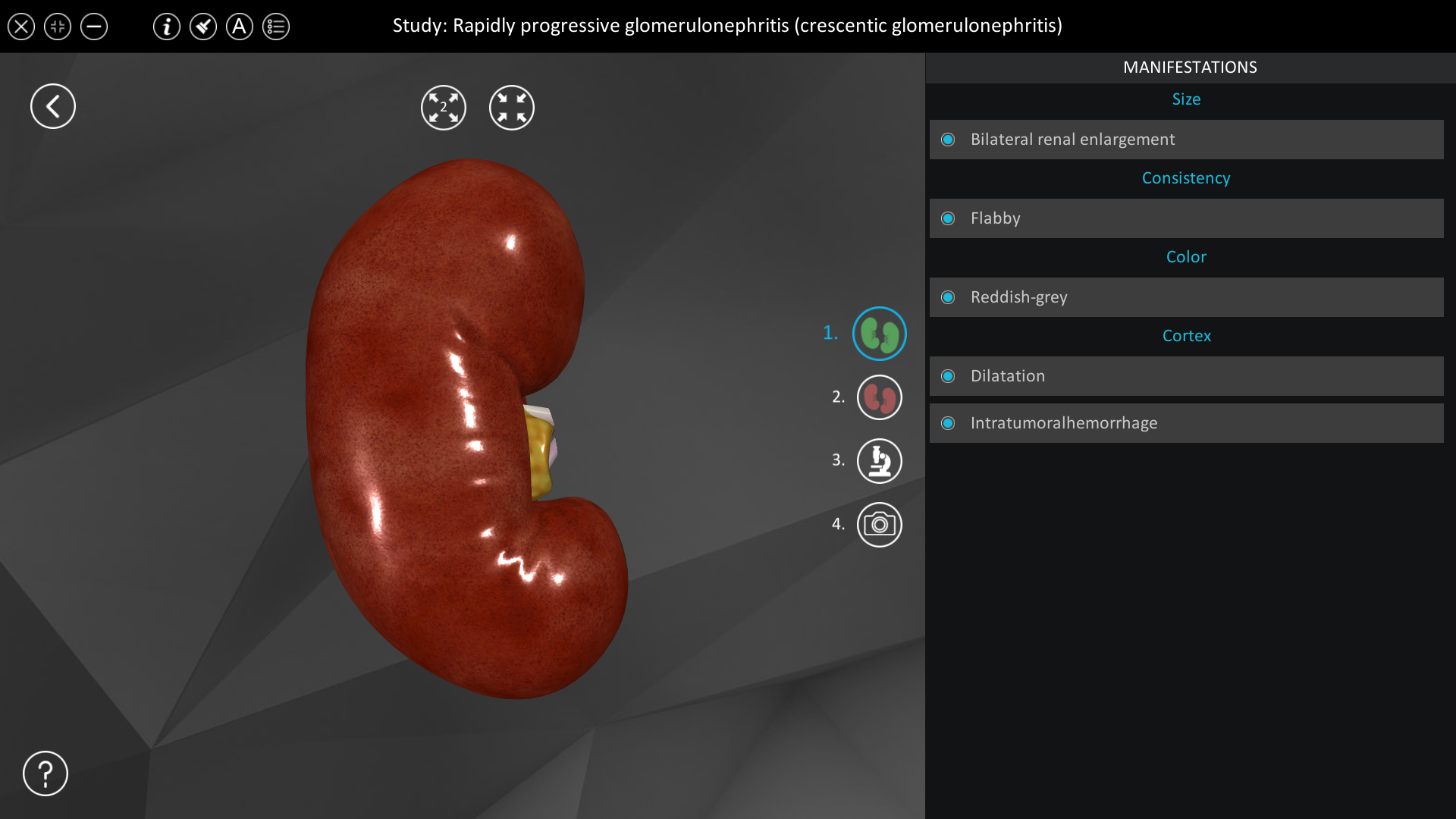 rapidly-progressive-glomerulonephritis-roqed